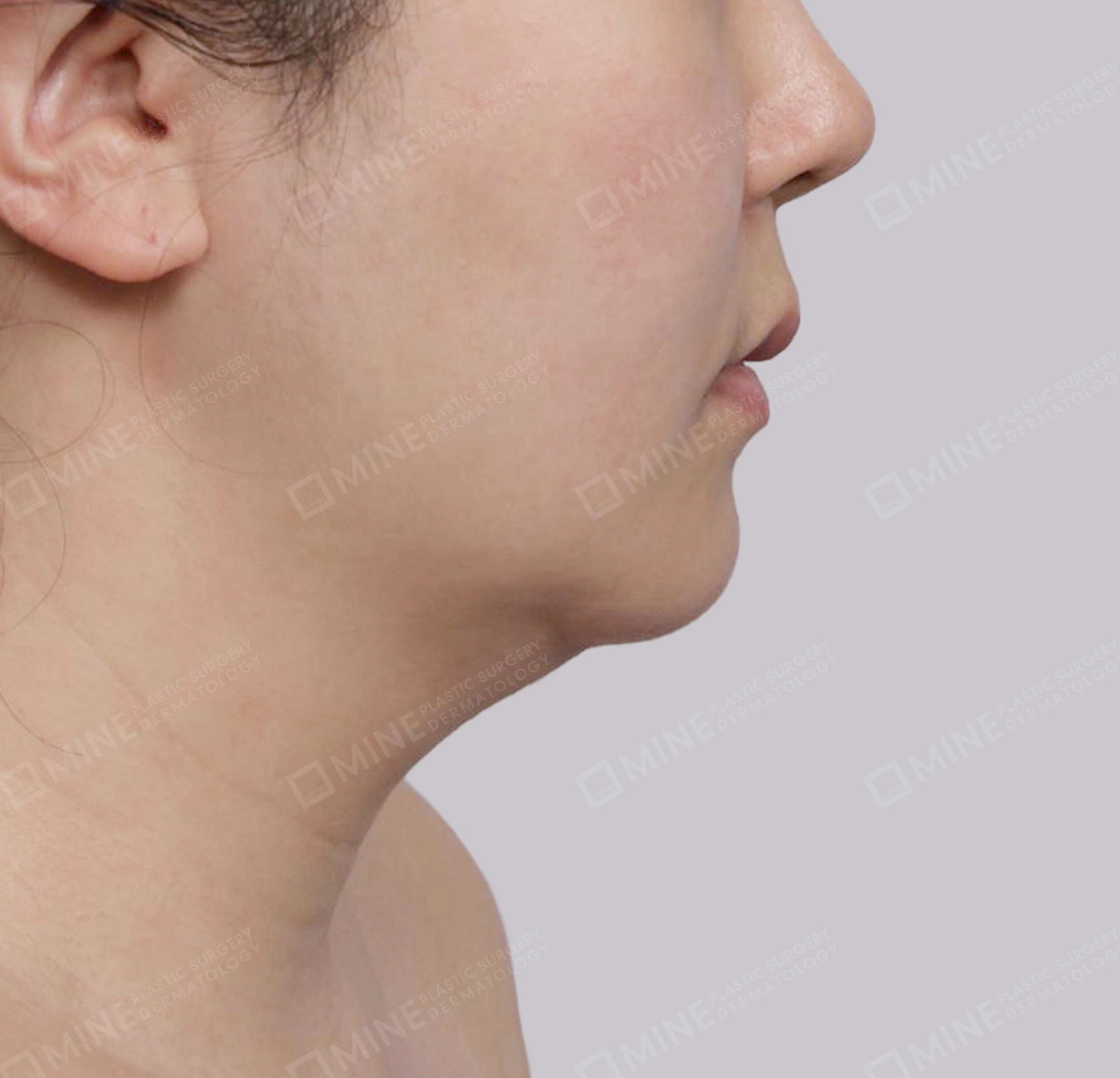 Mini Neck Lift-측면-전