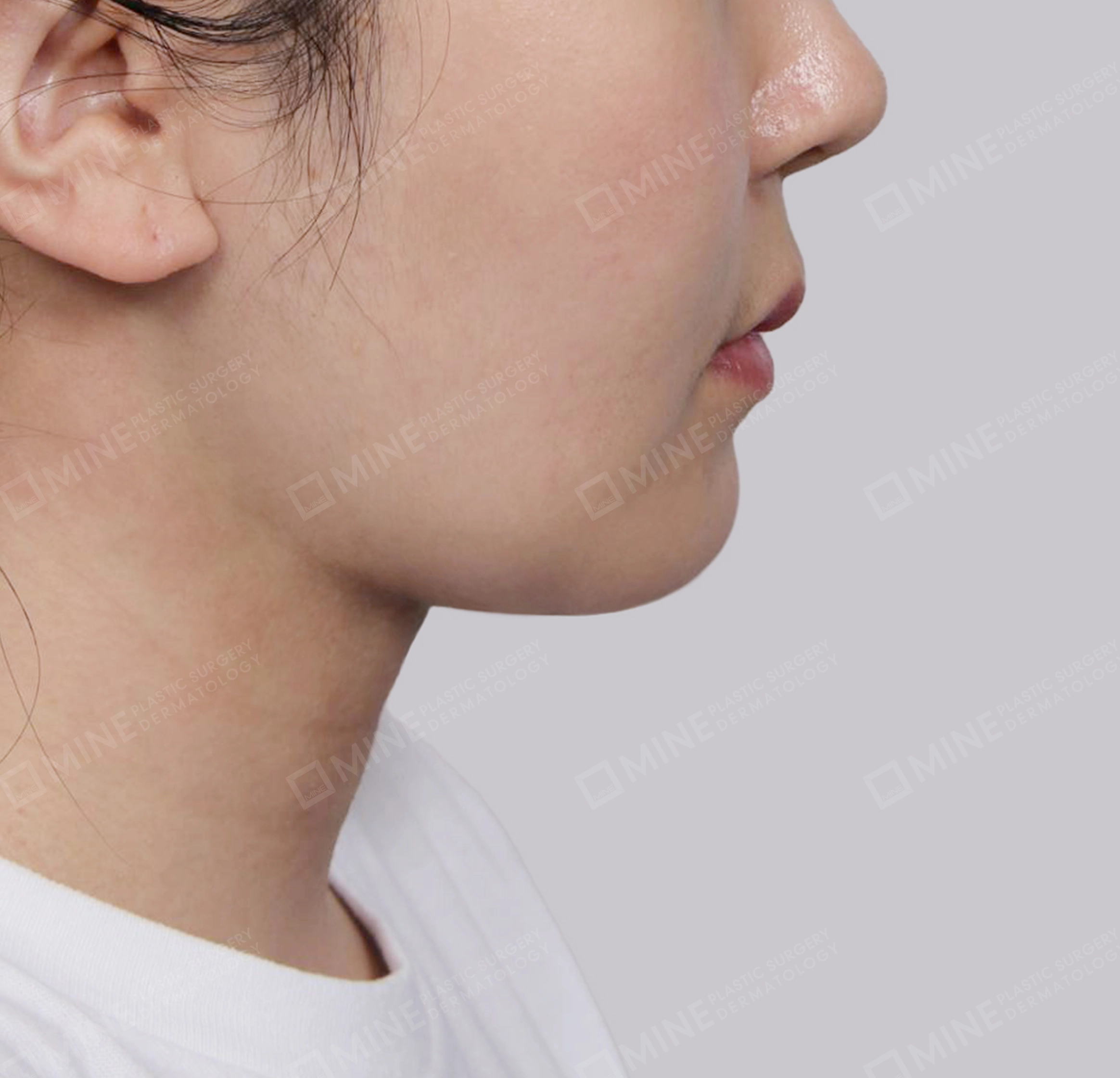 Mini Neck Lift-측면-후