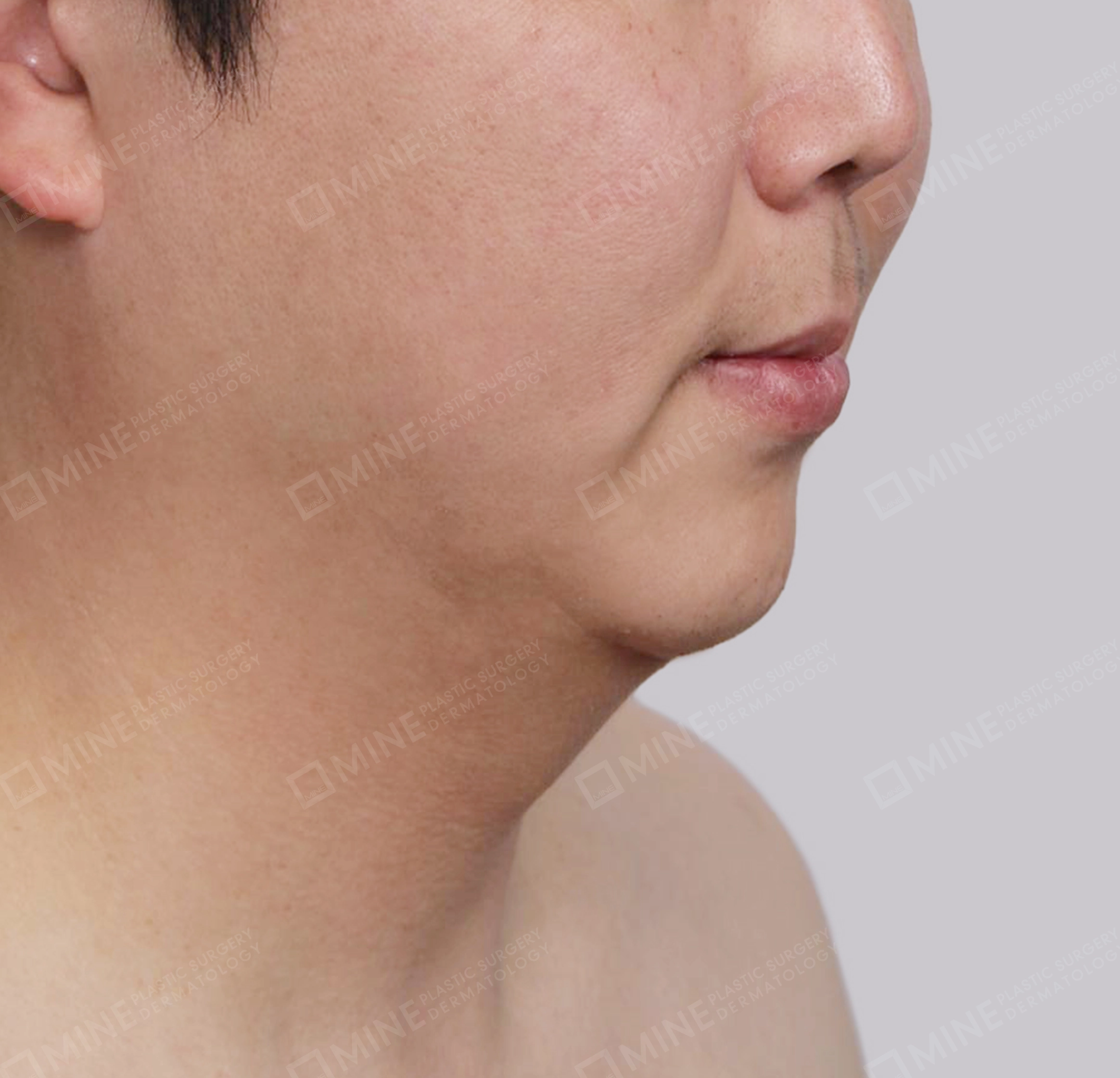 Mini Neck Lift-정면-전