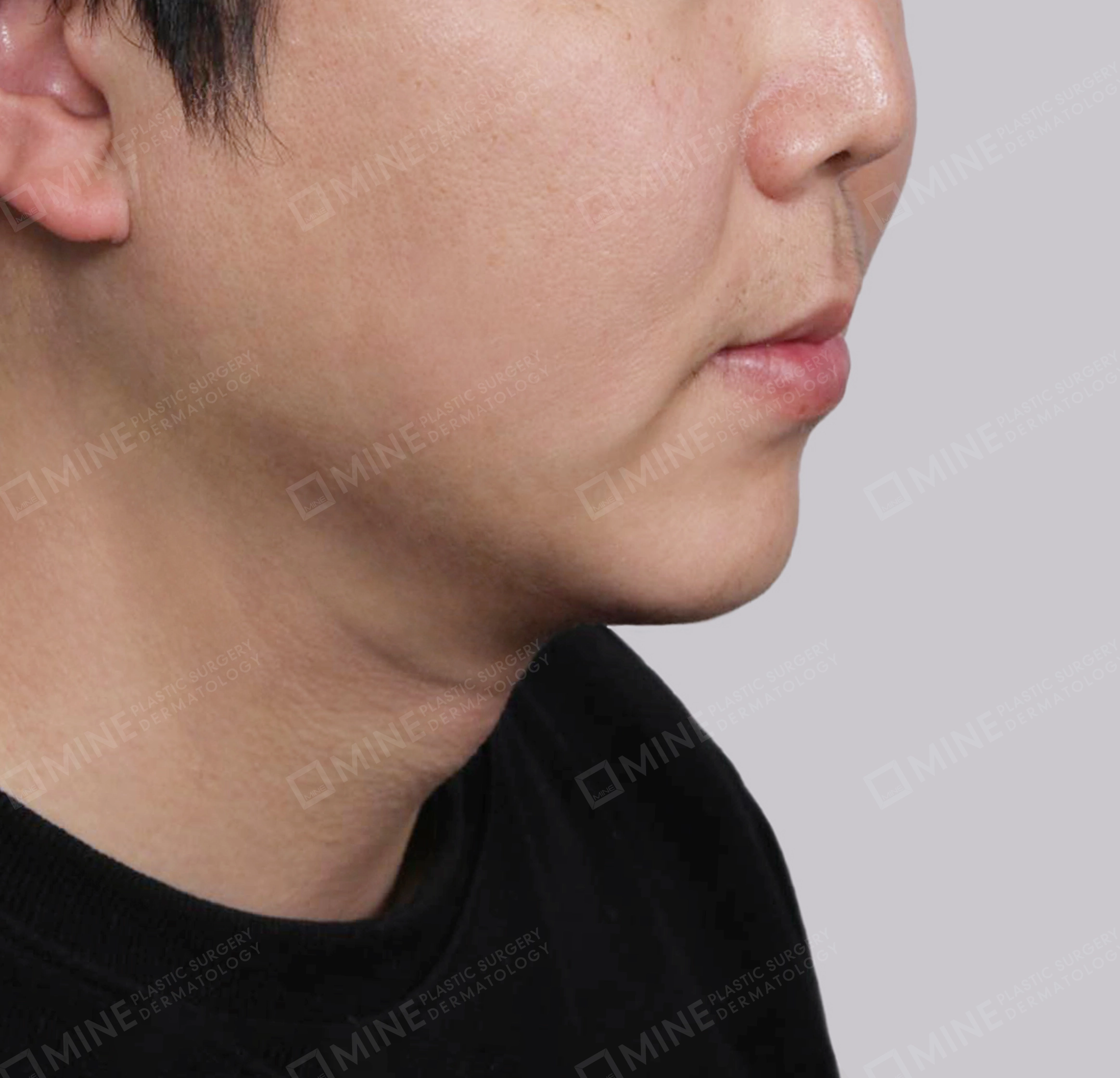 Mini Neck Lift-정면-후
