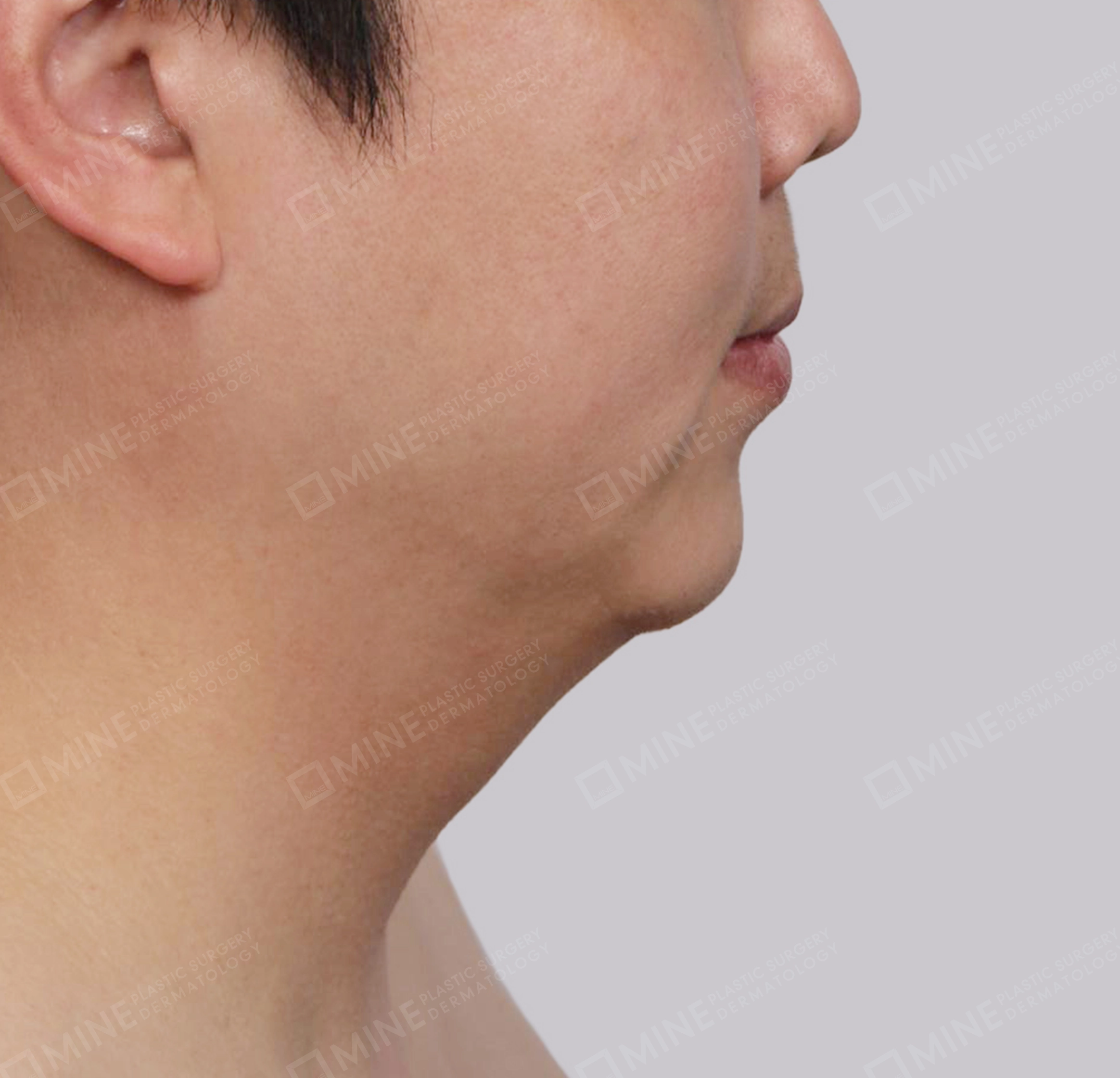 Mini Neck Lift-측면-전