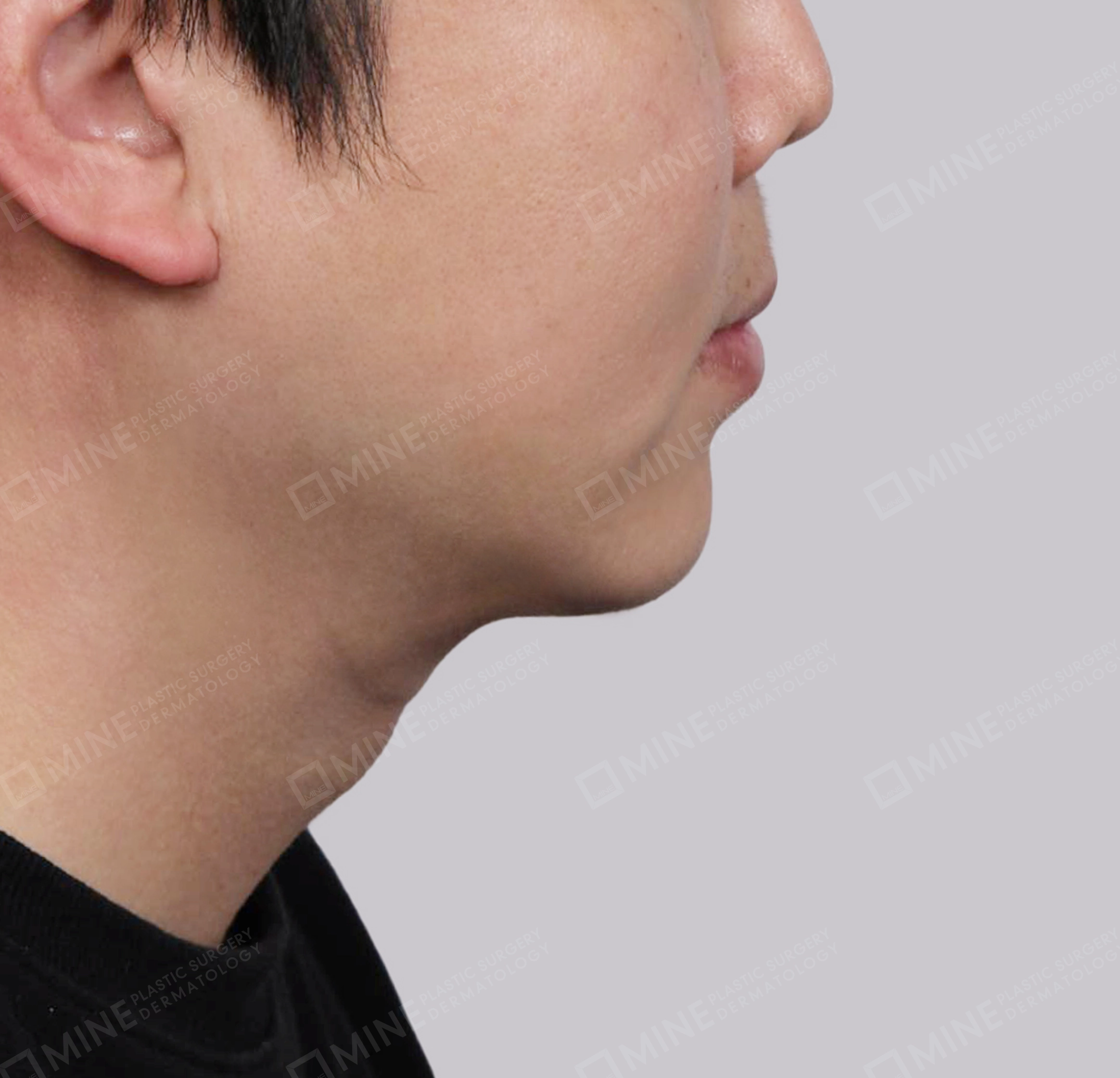 Mini Neck Lift-측면-후