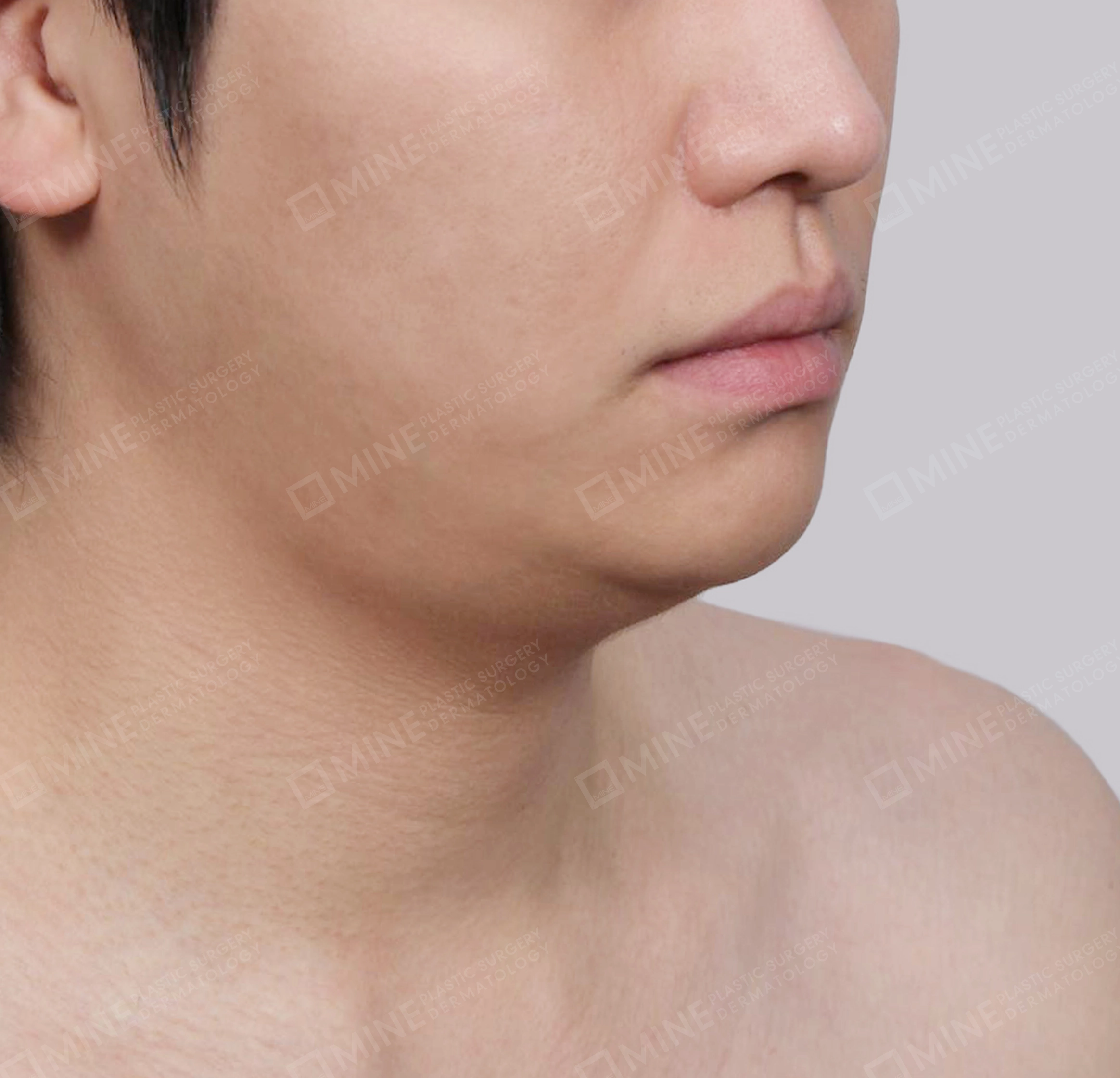 Mini Neck Lift-정면-전