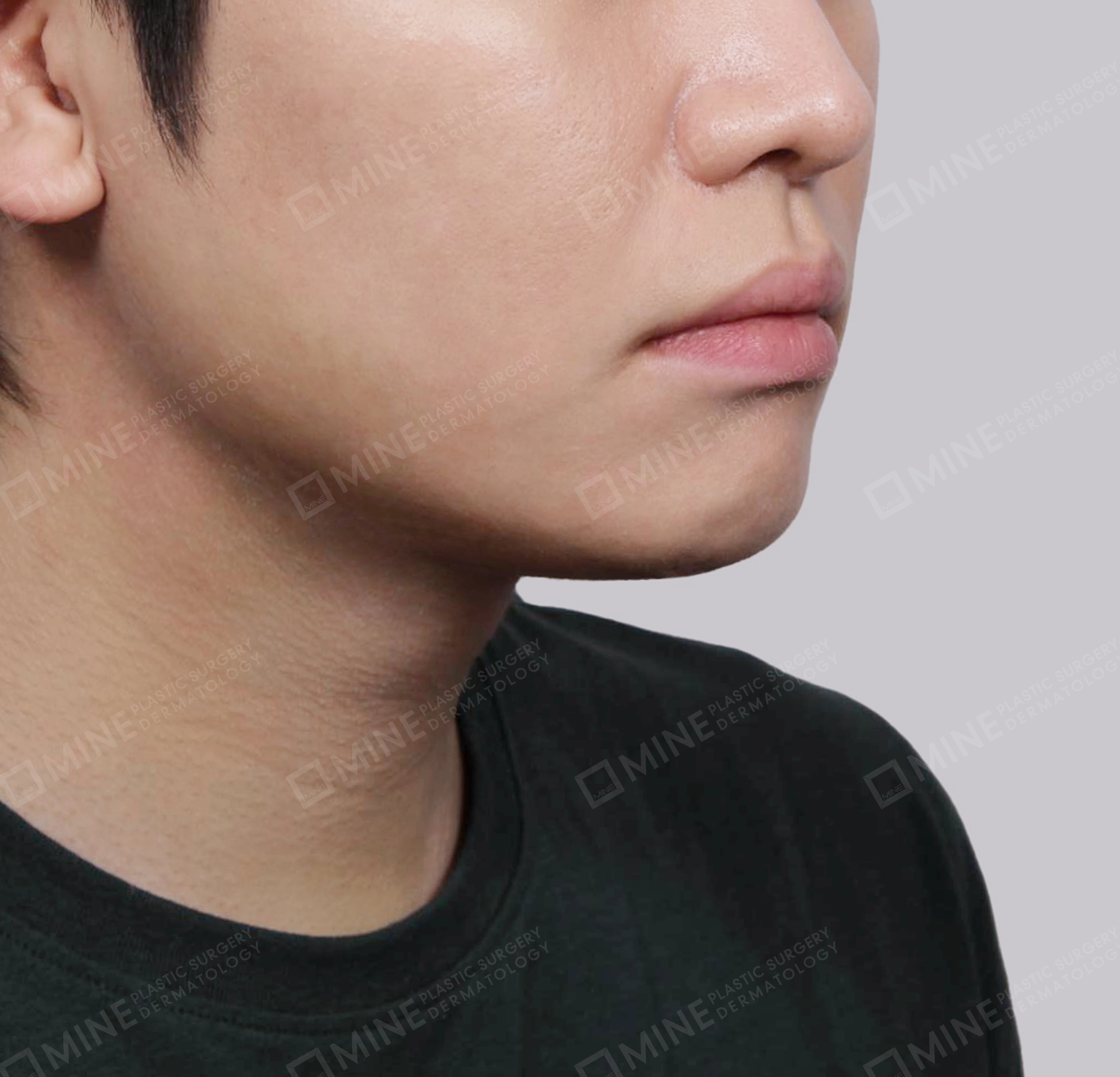 Mini Neck Lift-정면-후