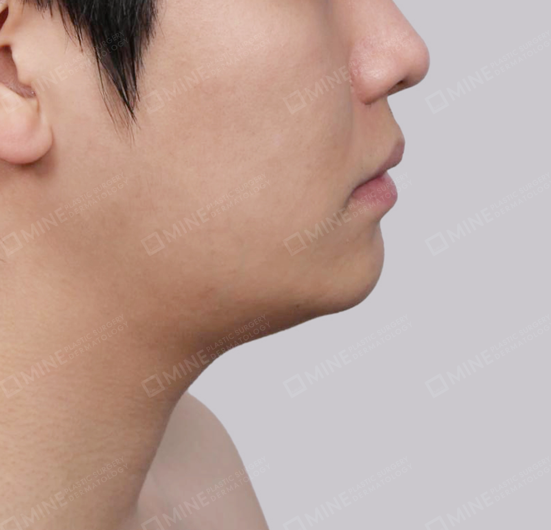 Mini Neck Lift-측면-전