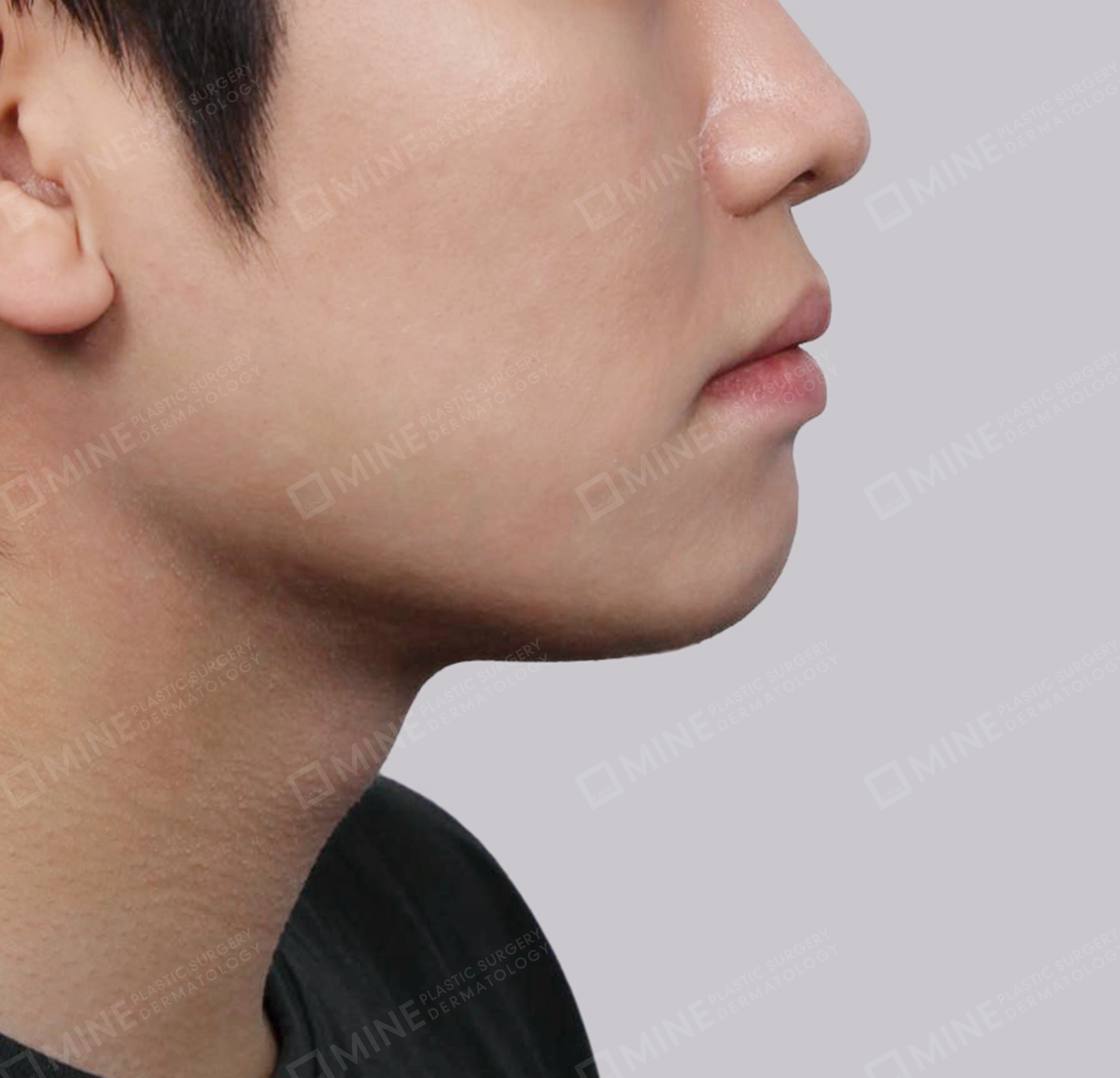 Mini Neck Lift-측면-후