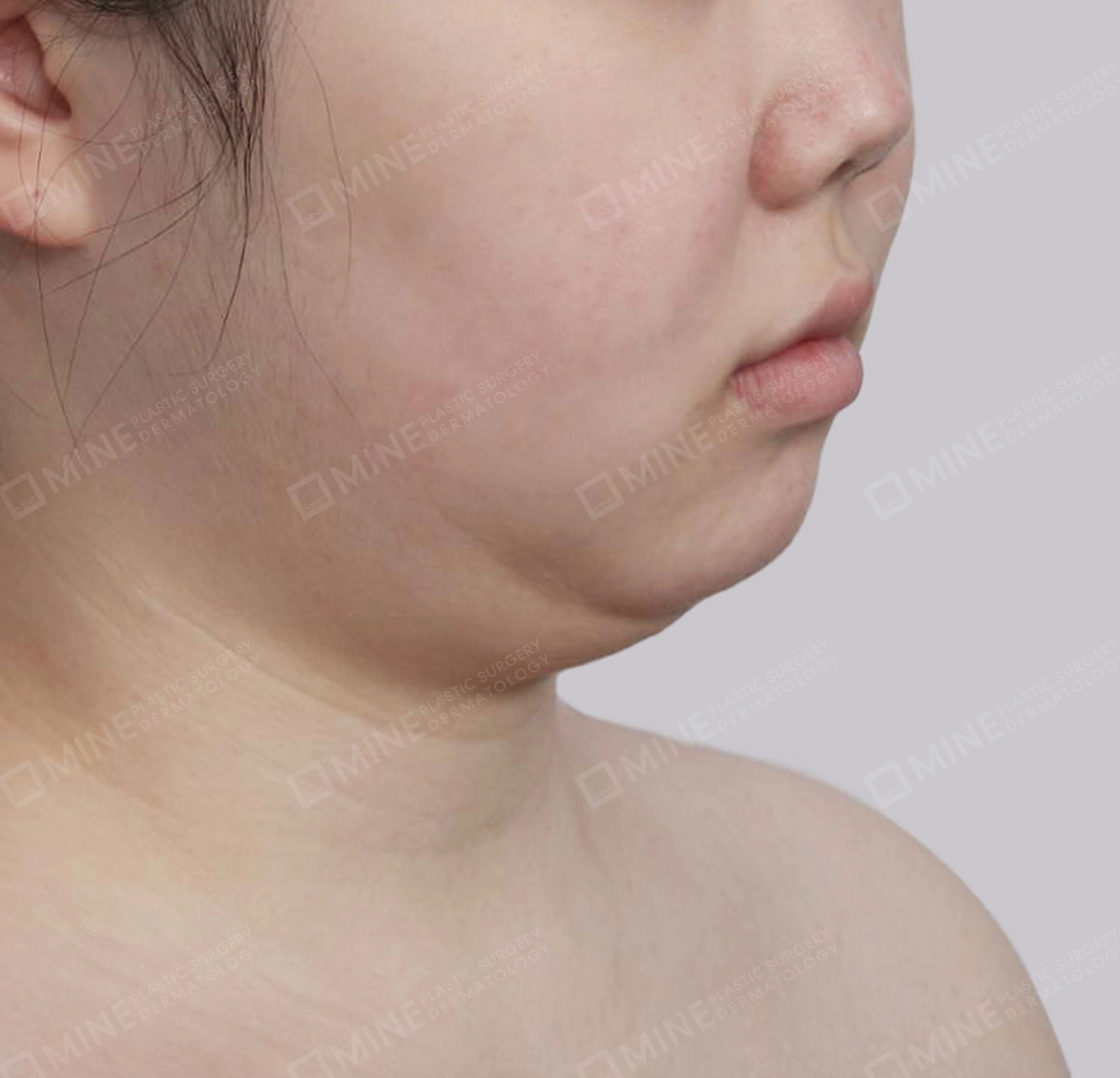 Mini Neck Lift-정면-전