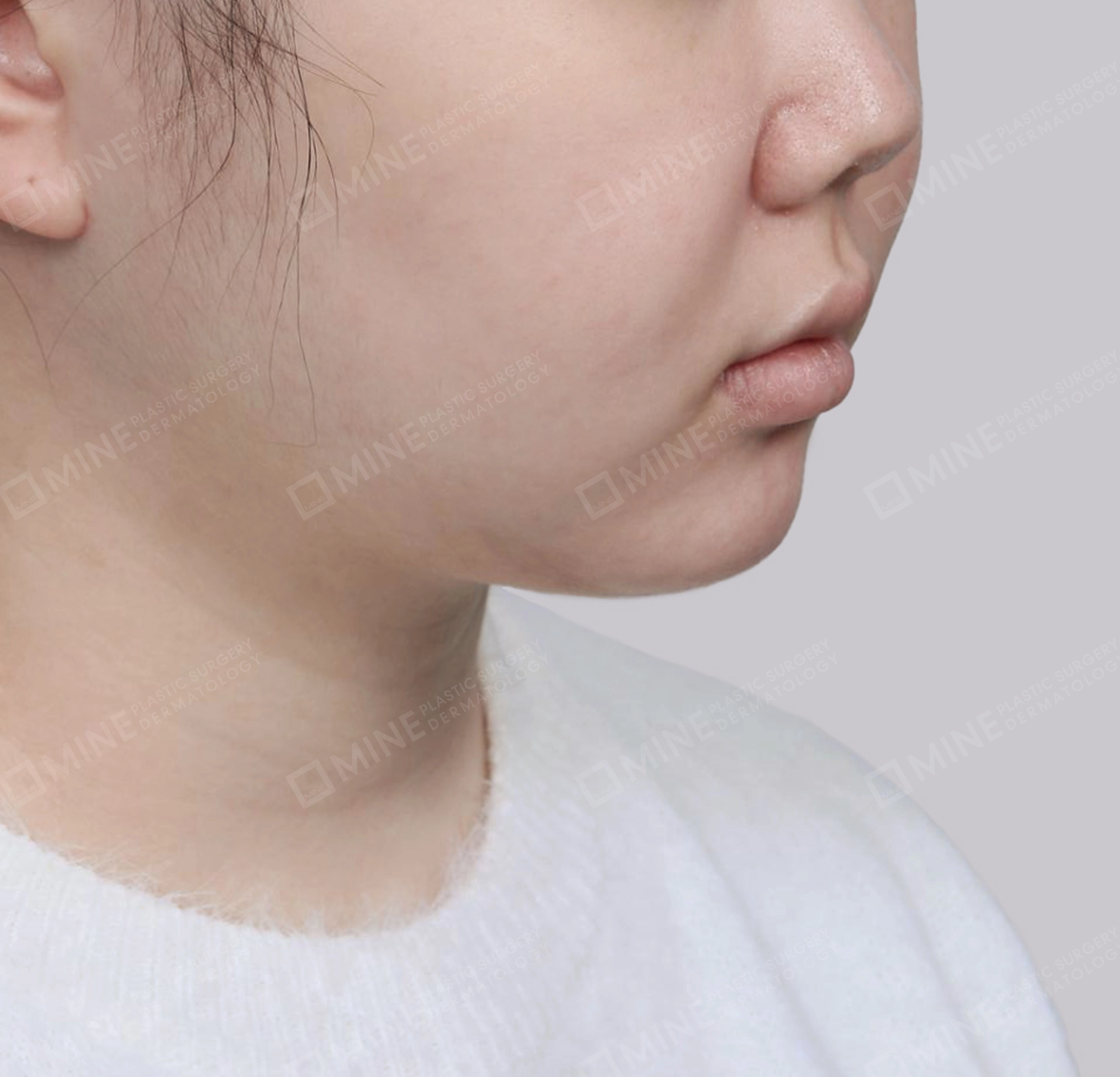 Mini Neck Lift-정면-후