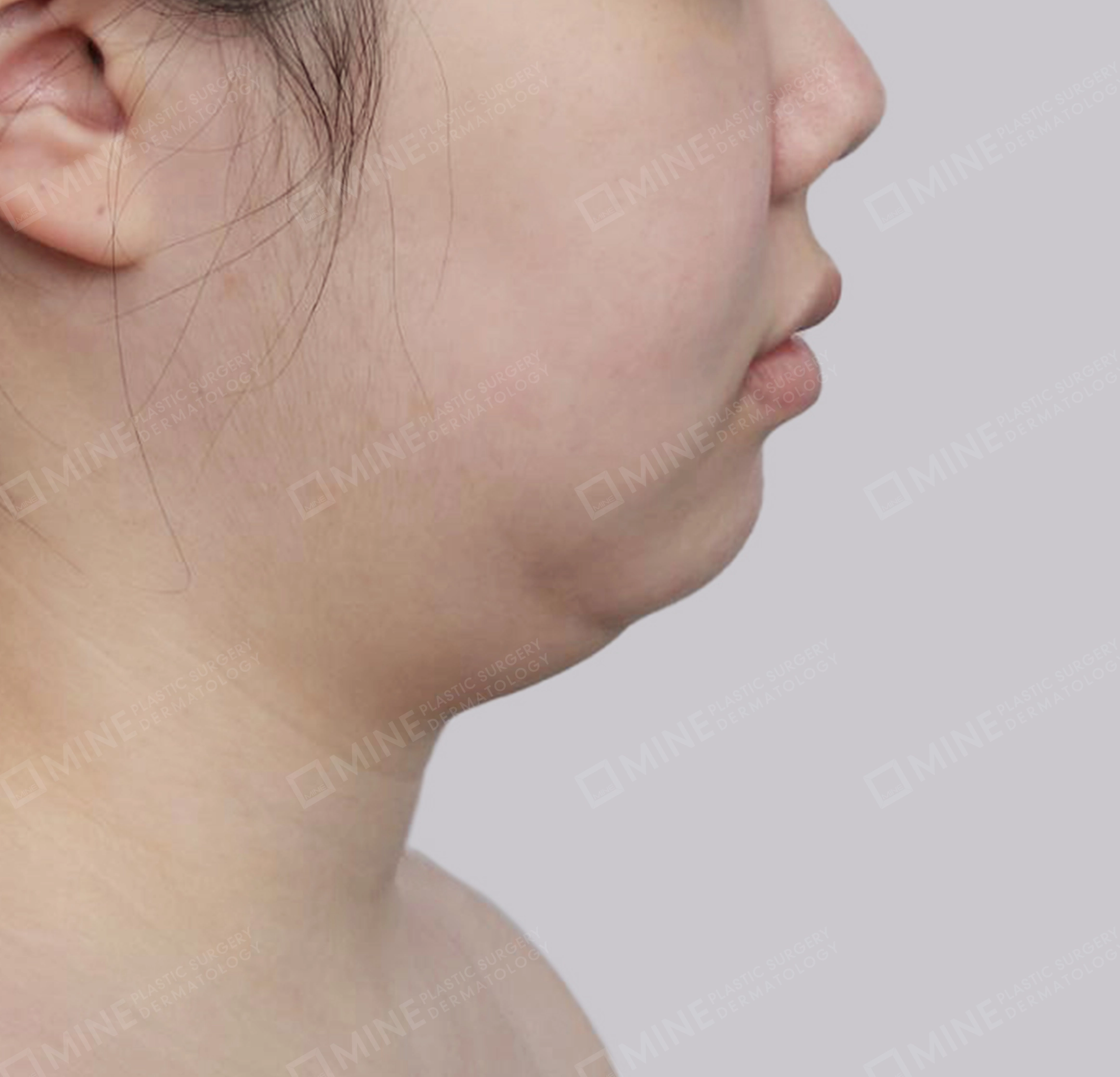 Mini Neck Lift-측면-전