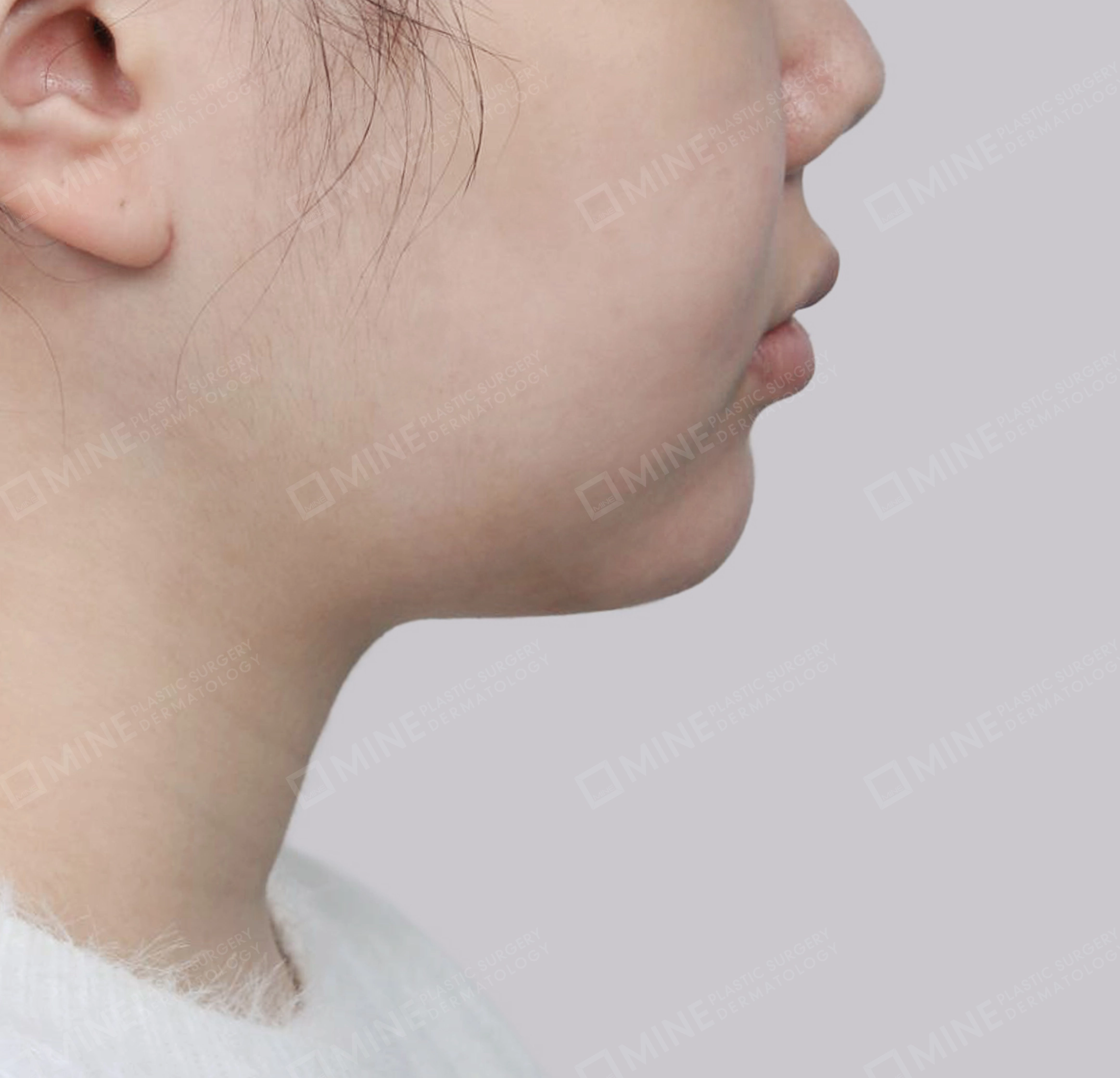 Mini Neck Lift-측면-후