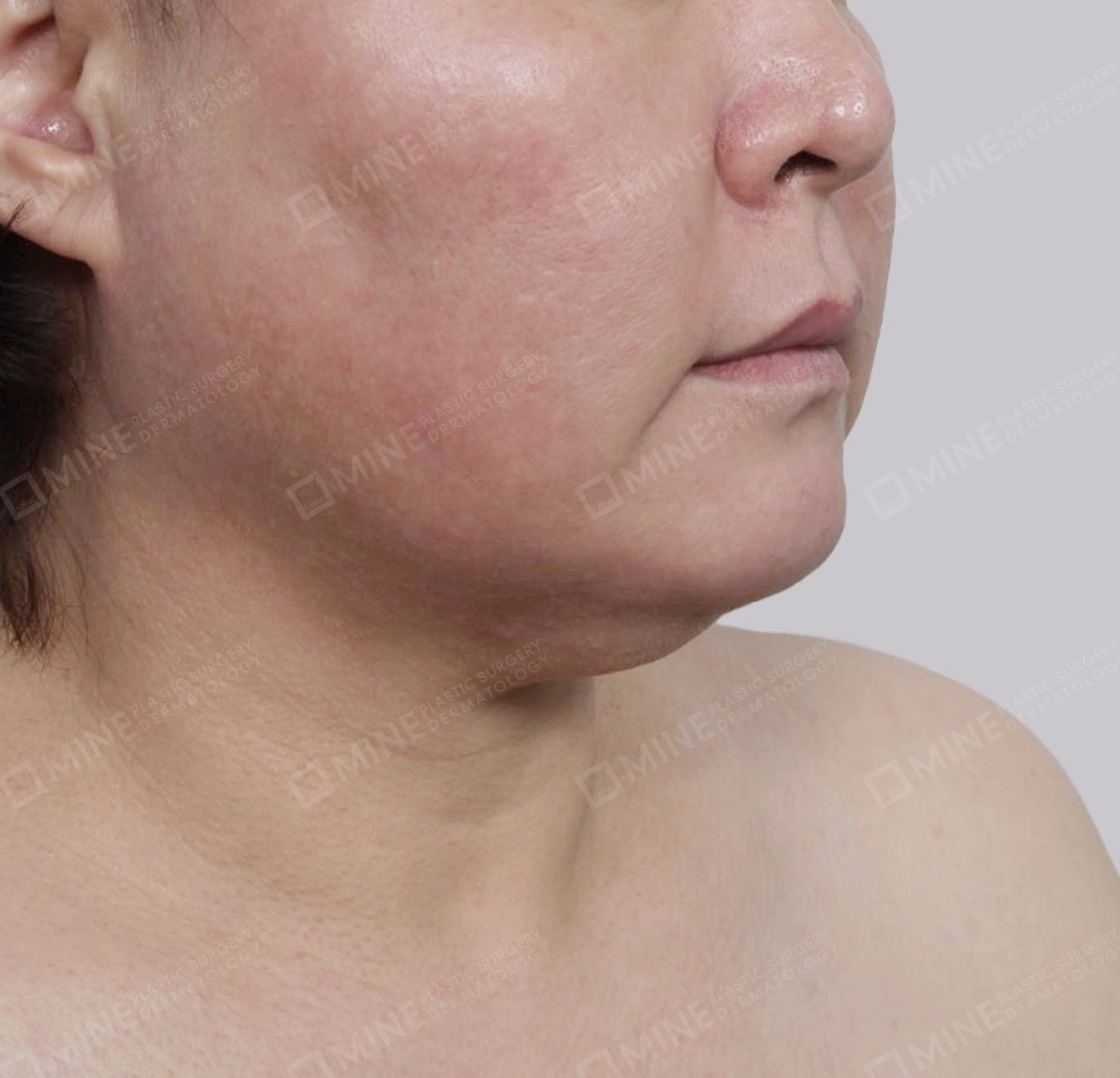 Mini Neck Lift-정면-전