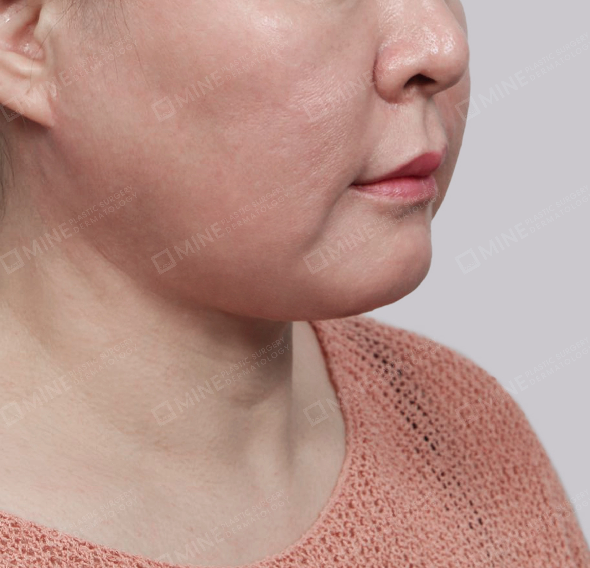 Mini Neck Lift-정면-후