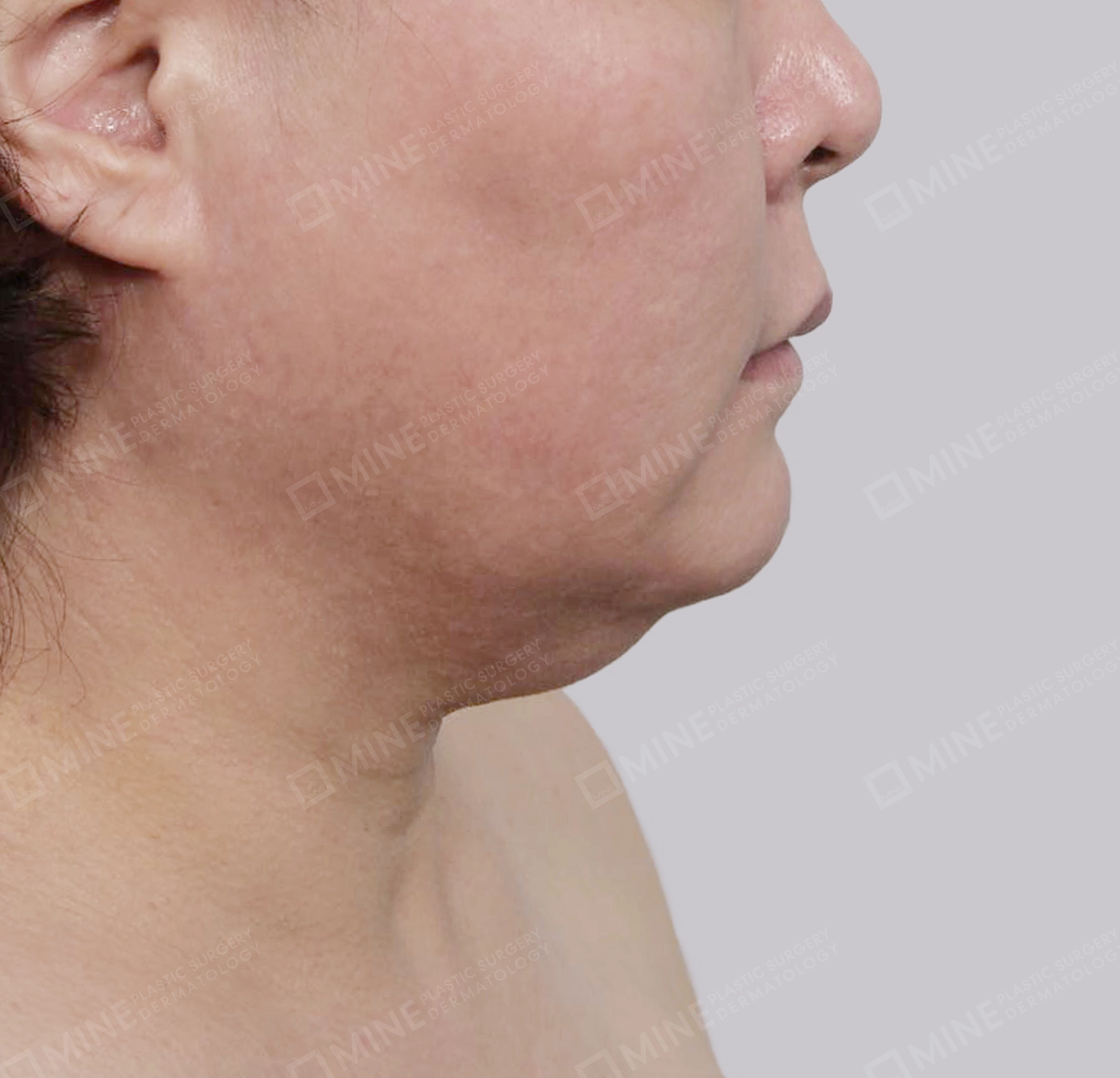 Mini Neck Lift-측면-전