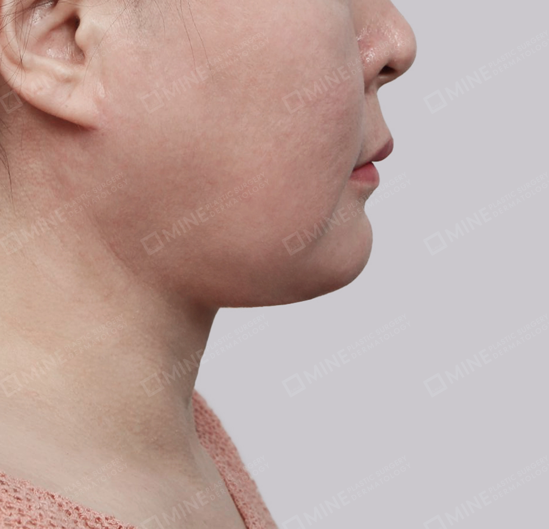 Mini Neck Lift-측면-후