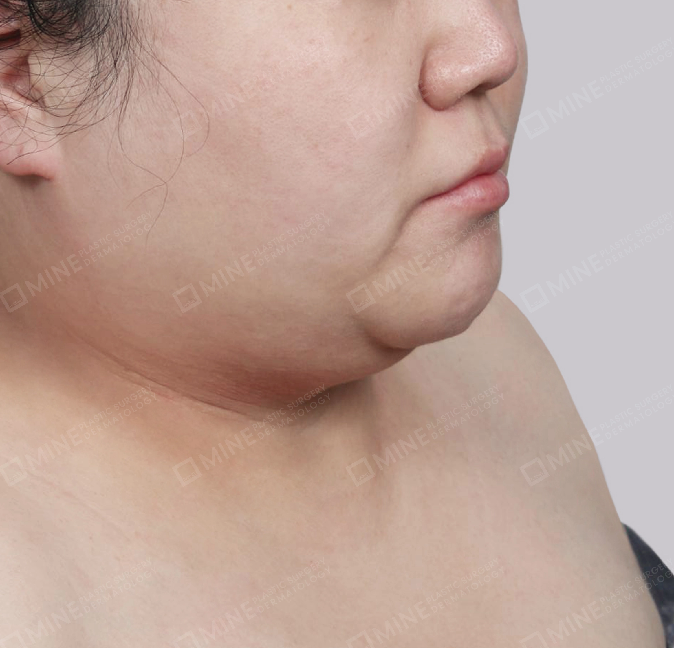 Mini Neck Lift-정면-전