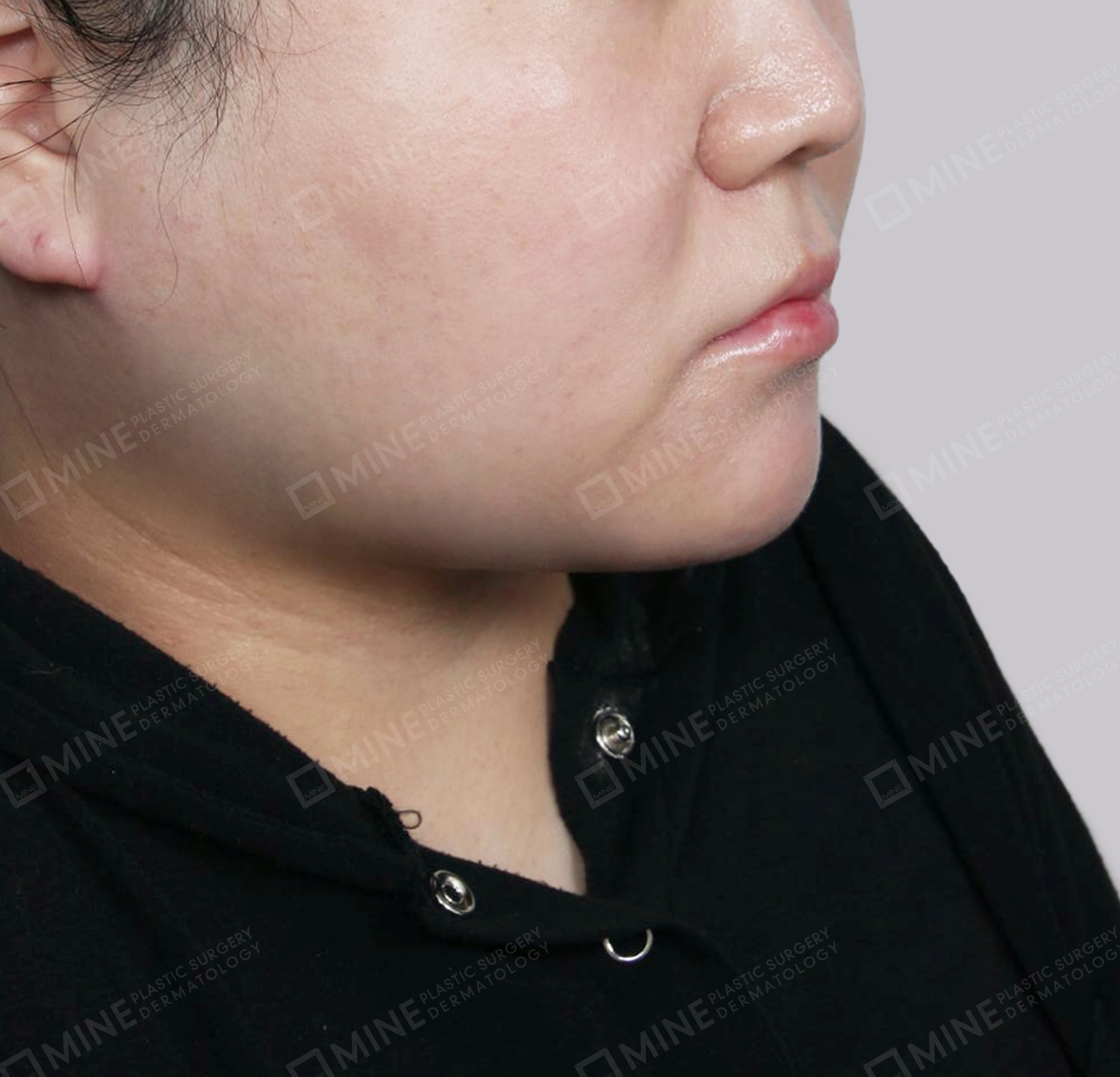 Mini Neck Lift-정면-후