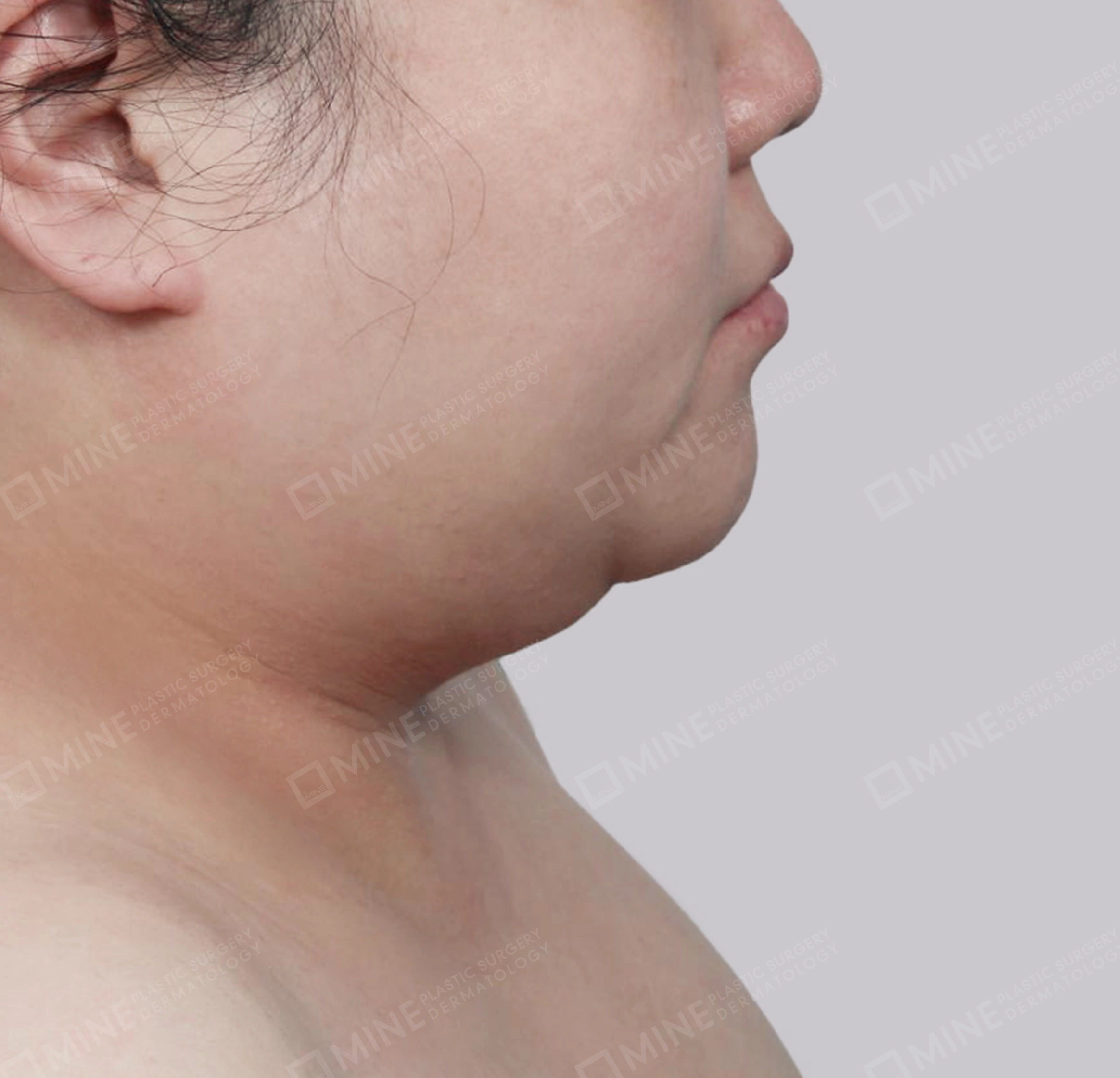 Mini Neck Lift-측면-전