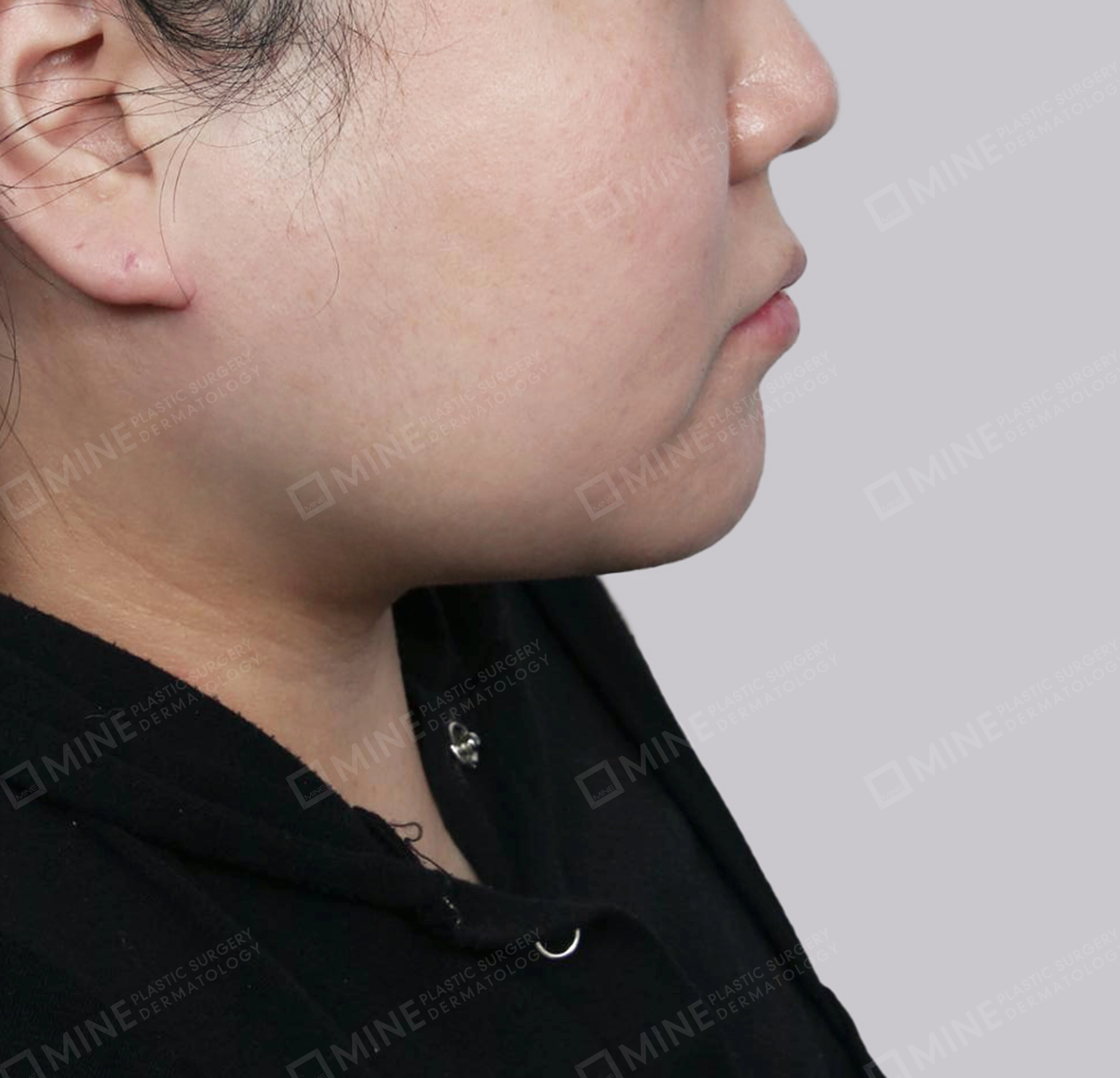 Mini Neck Lift-측면-후