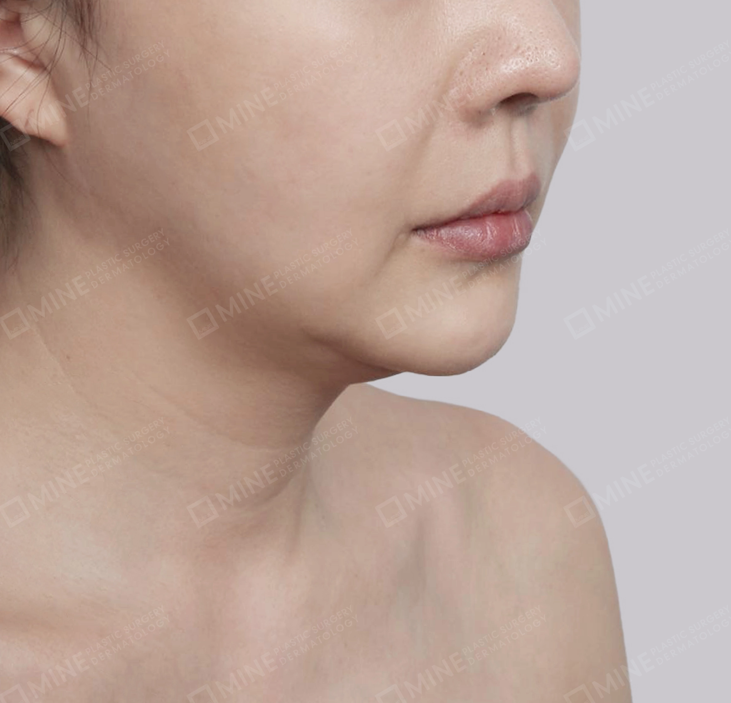 Mini Neck Lift-정면-전