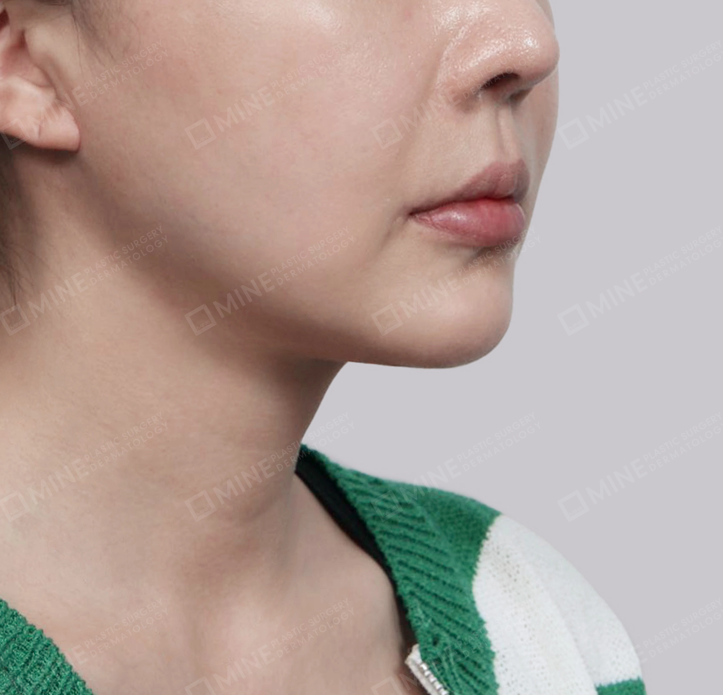 Mini Neck Lift-정면-후