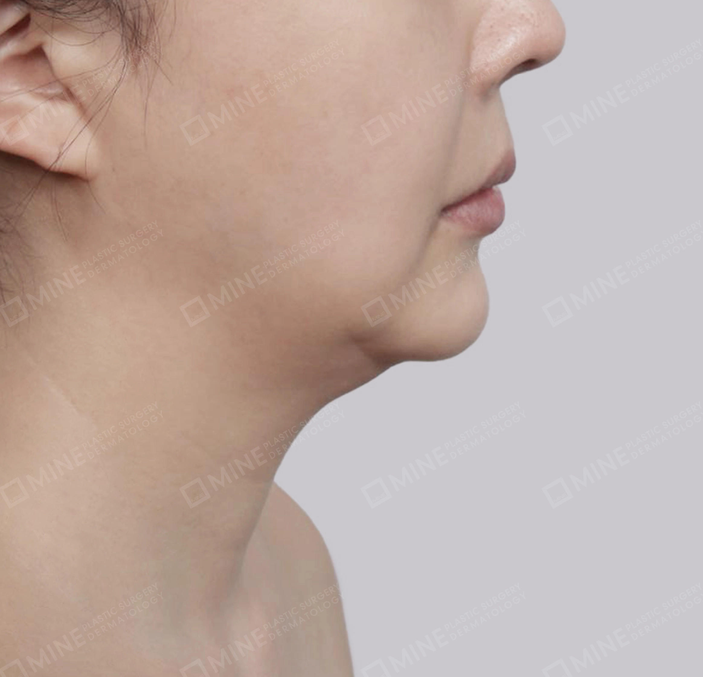 Mini Neck Lift-측면-전