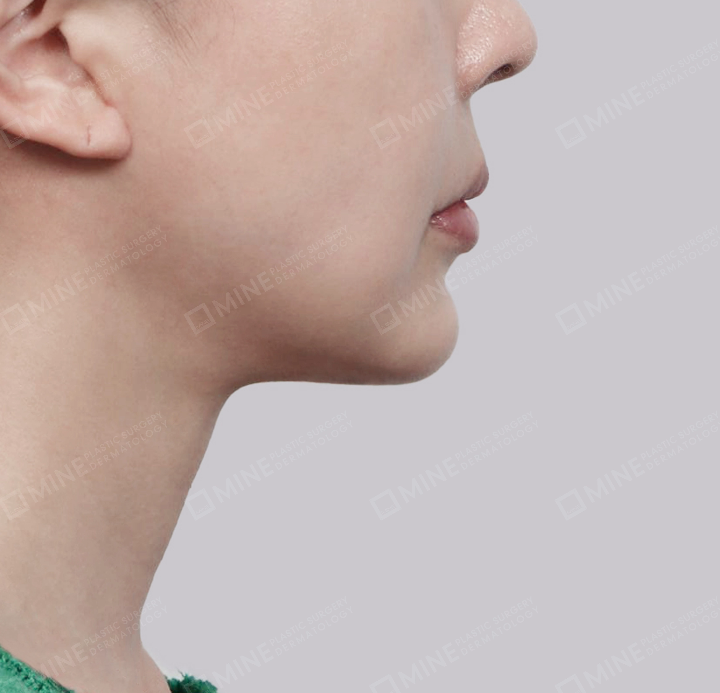 Mini Neck Lift-측면-후