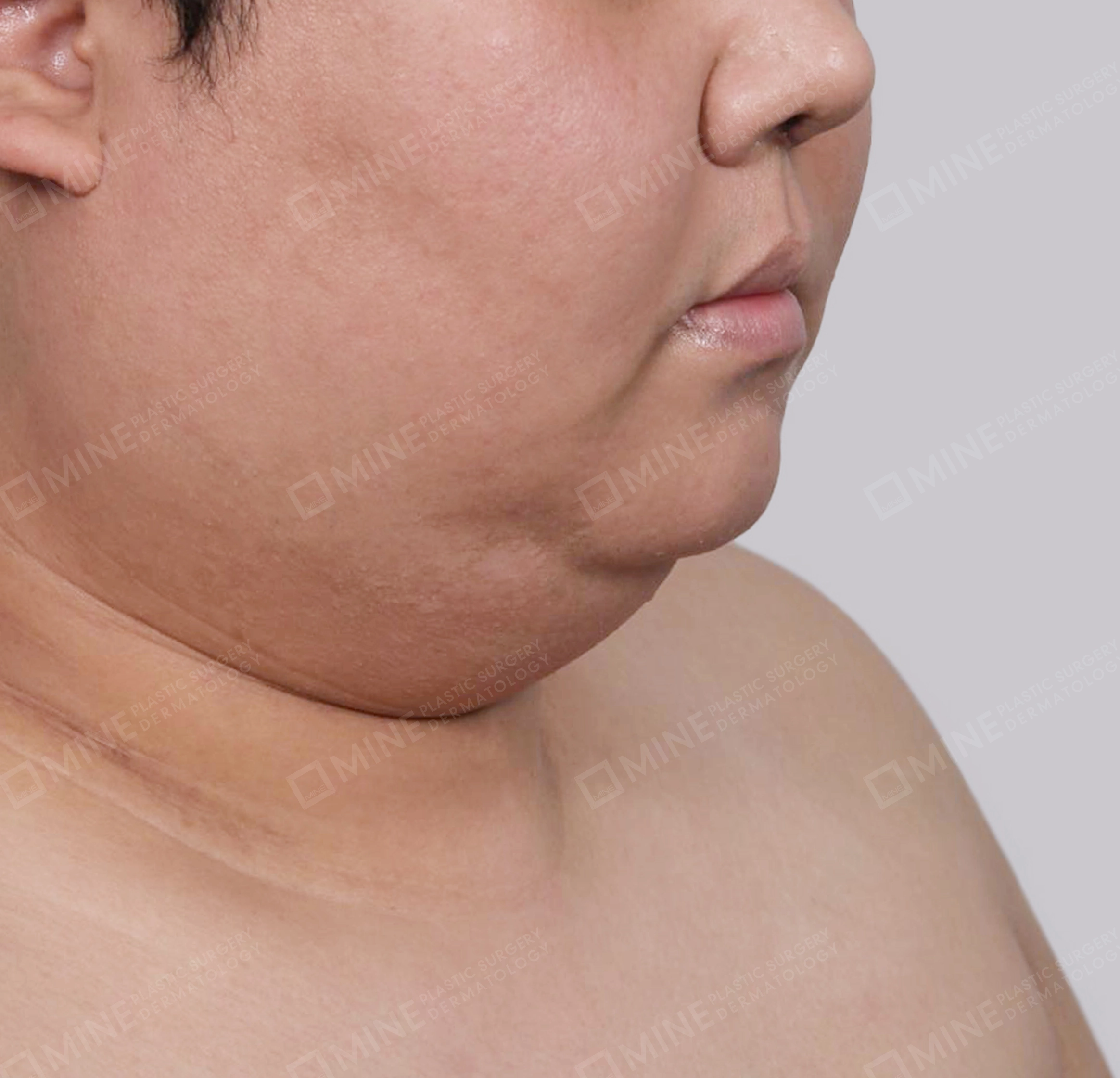 Mini Neck Lift-정면-전