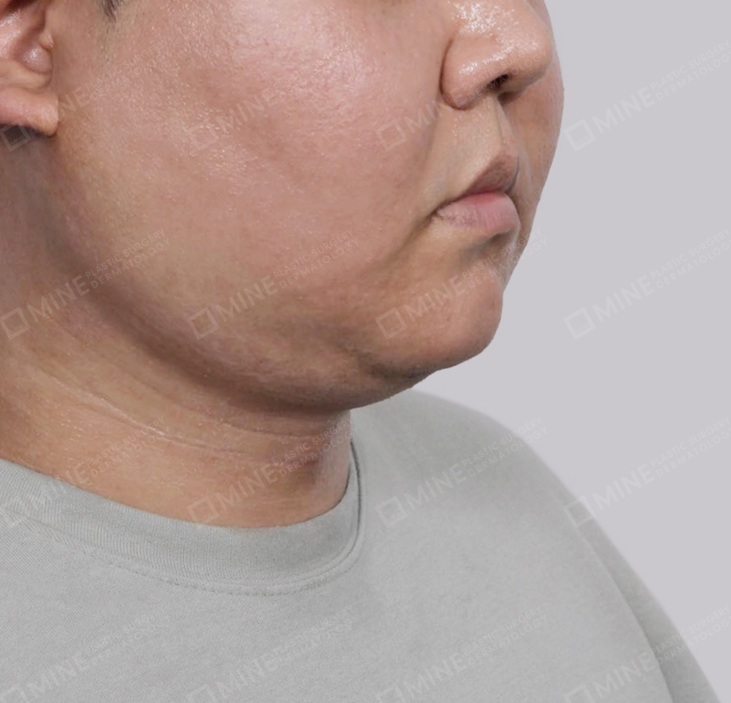 Mini Neck Lift-정면-후