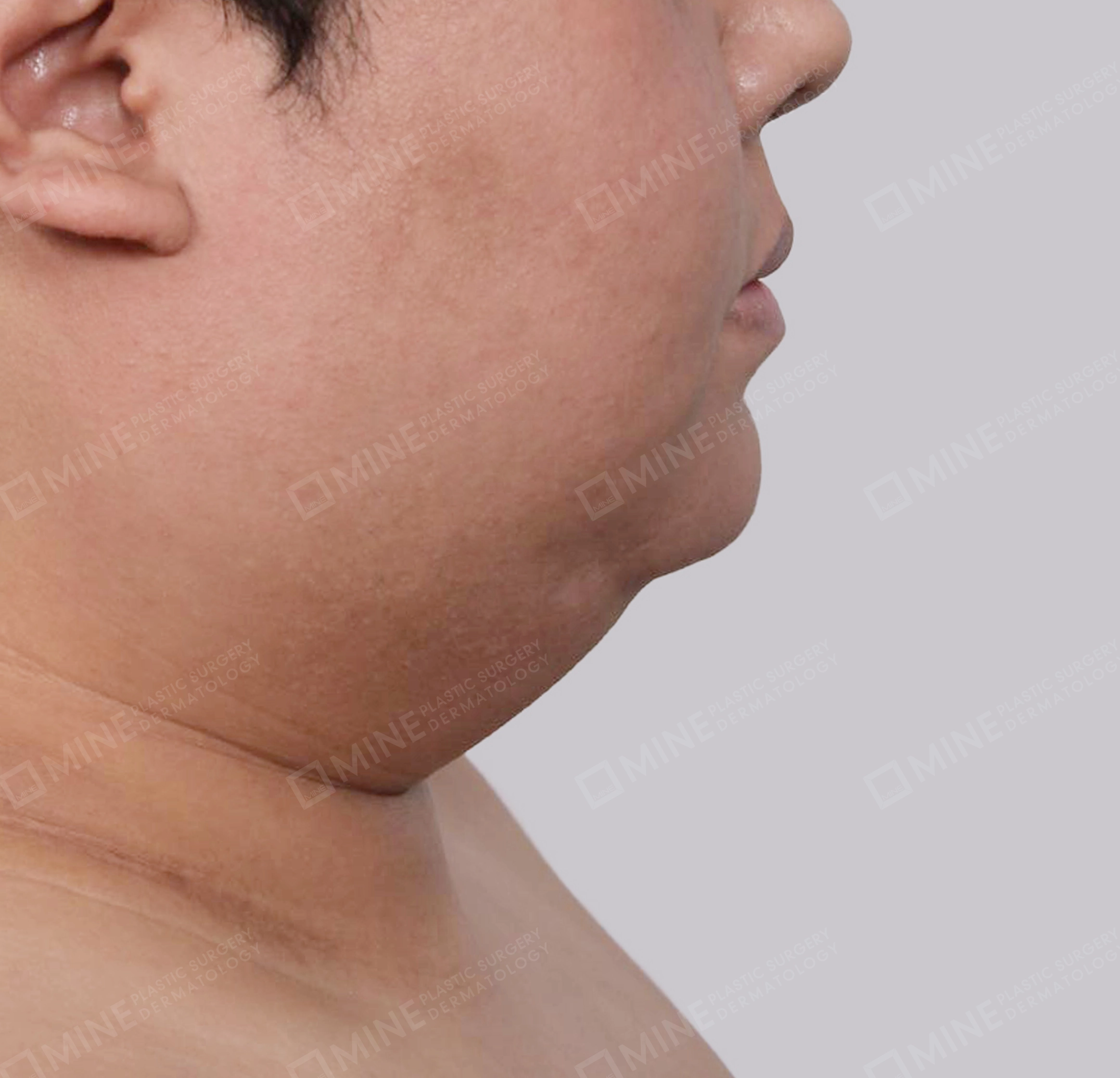 Mini Neck Lift-측면-전