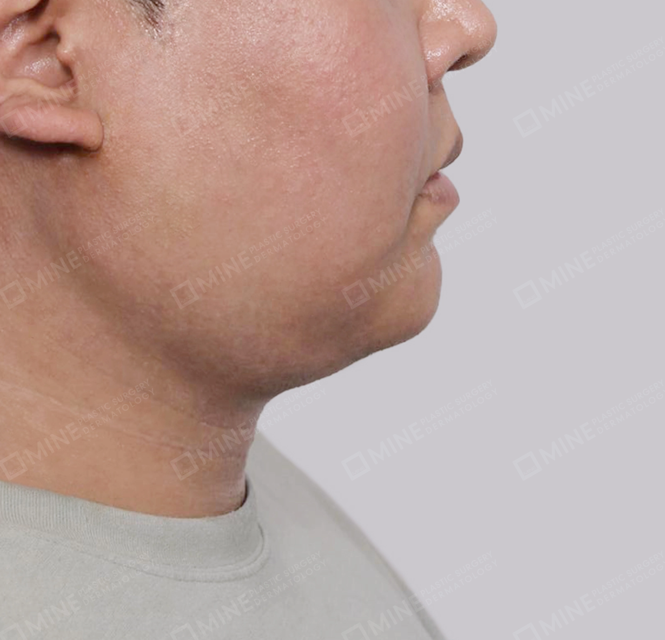 Mini Neck Lift-측면-후
