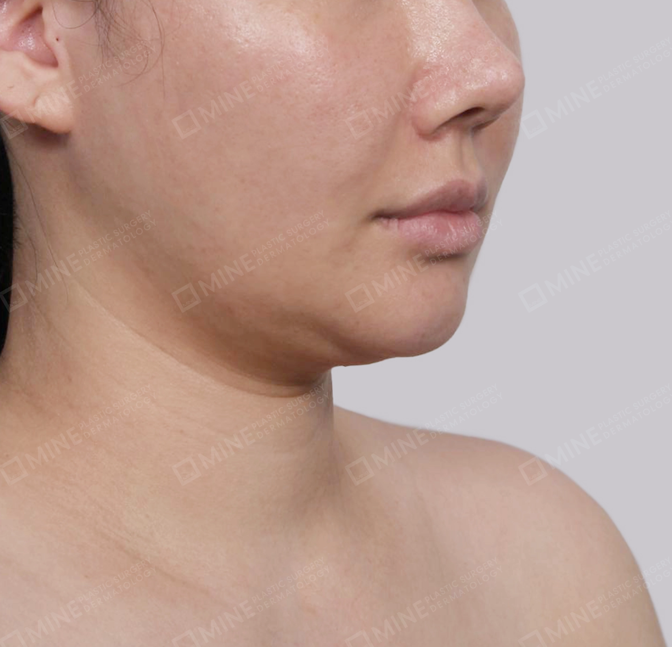 Mini Neck Lift-정면-전