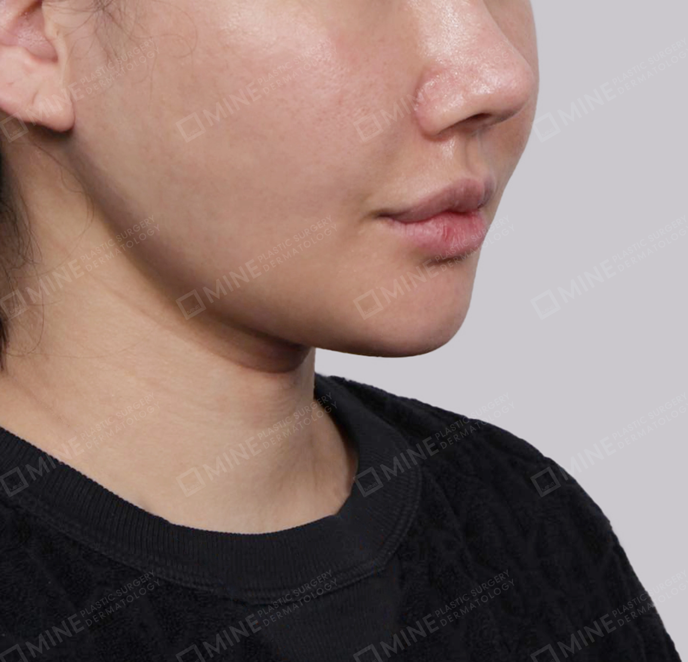 Mini Neck Lift-정면-후