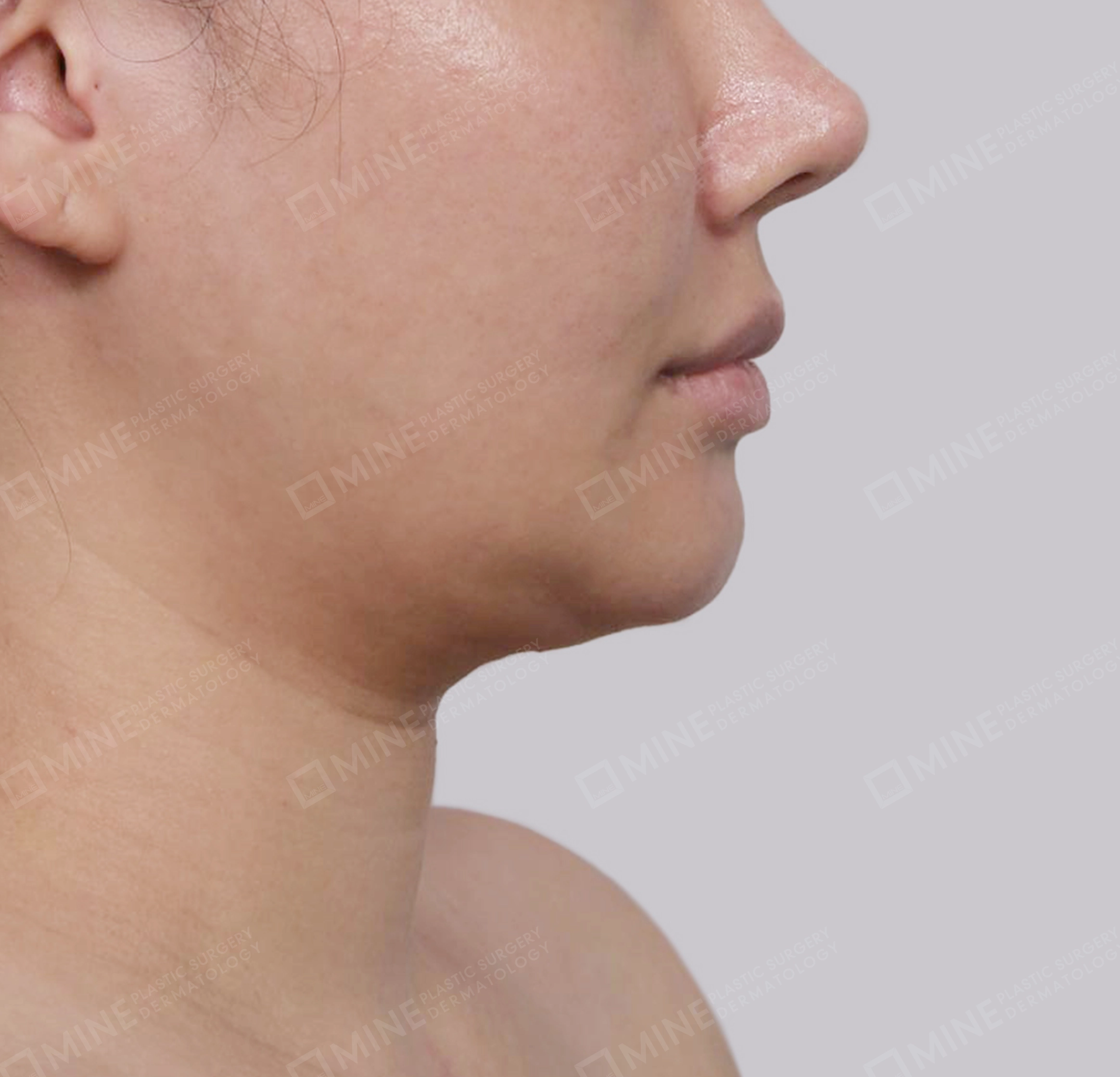 Mini Neck Lift-측면-전