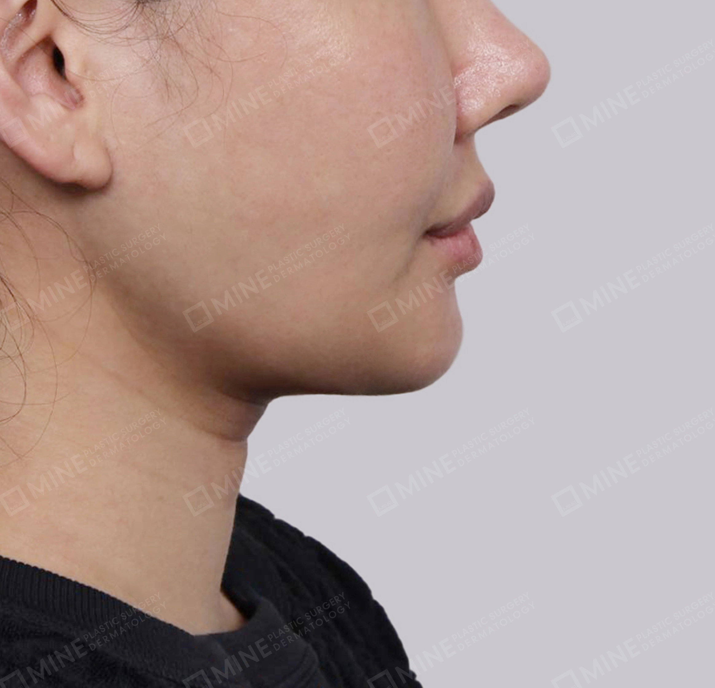 Mini Neck Lift-측면-후