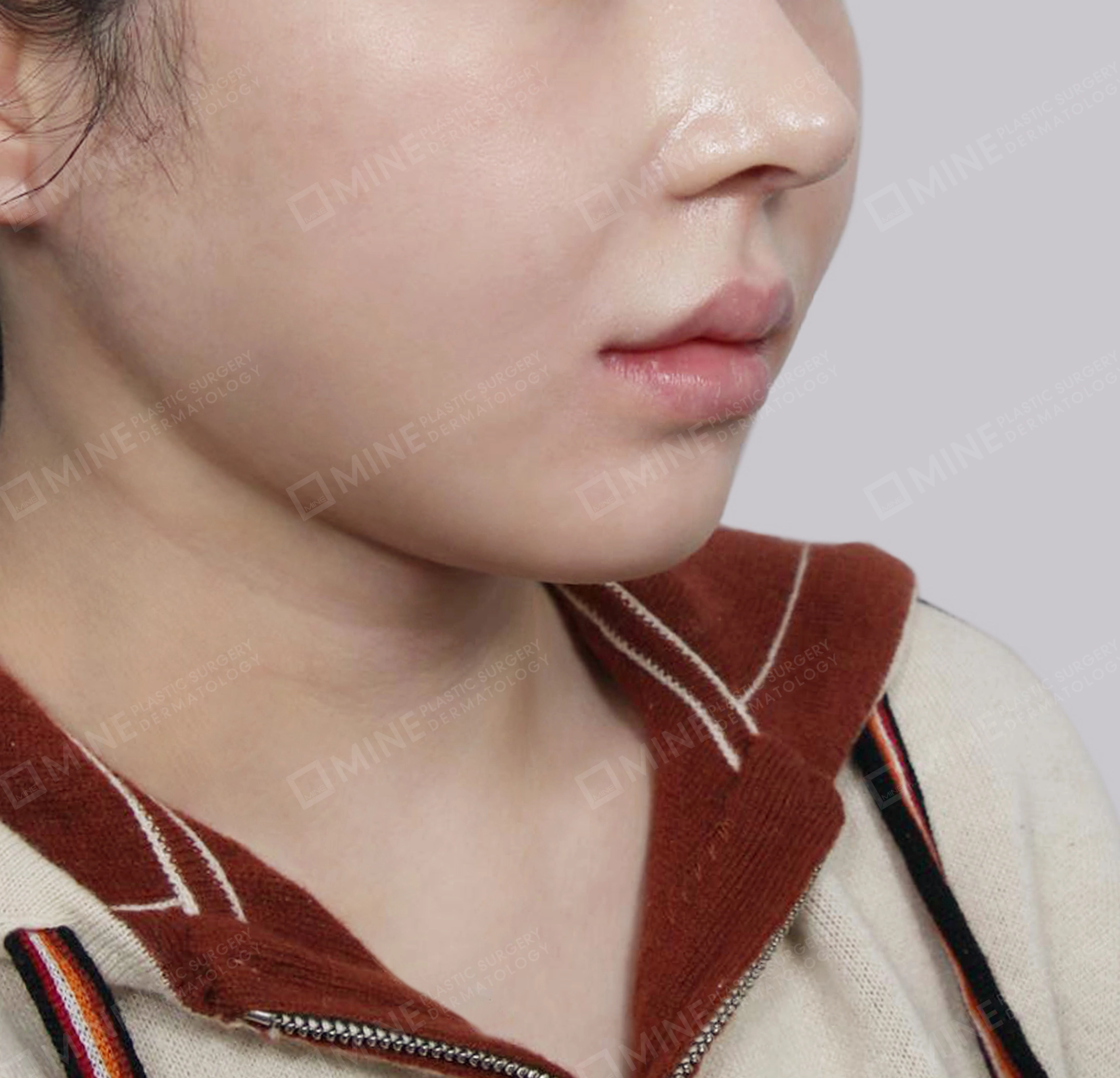 Mini Neck Lift-정면-후