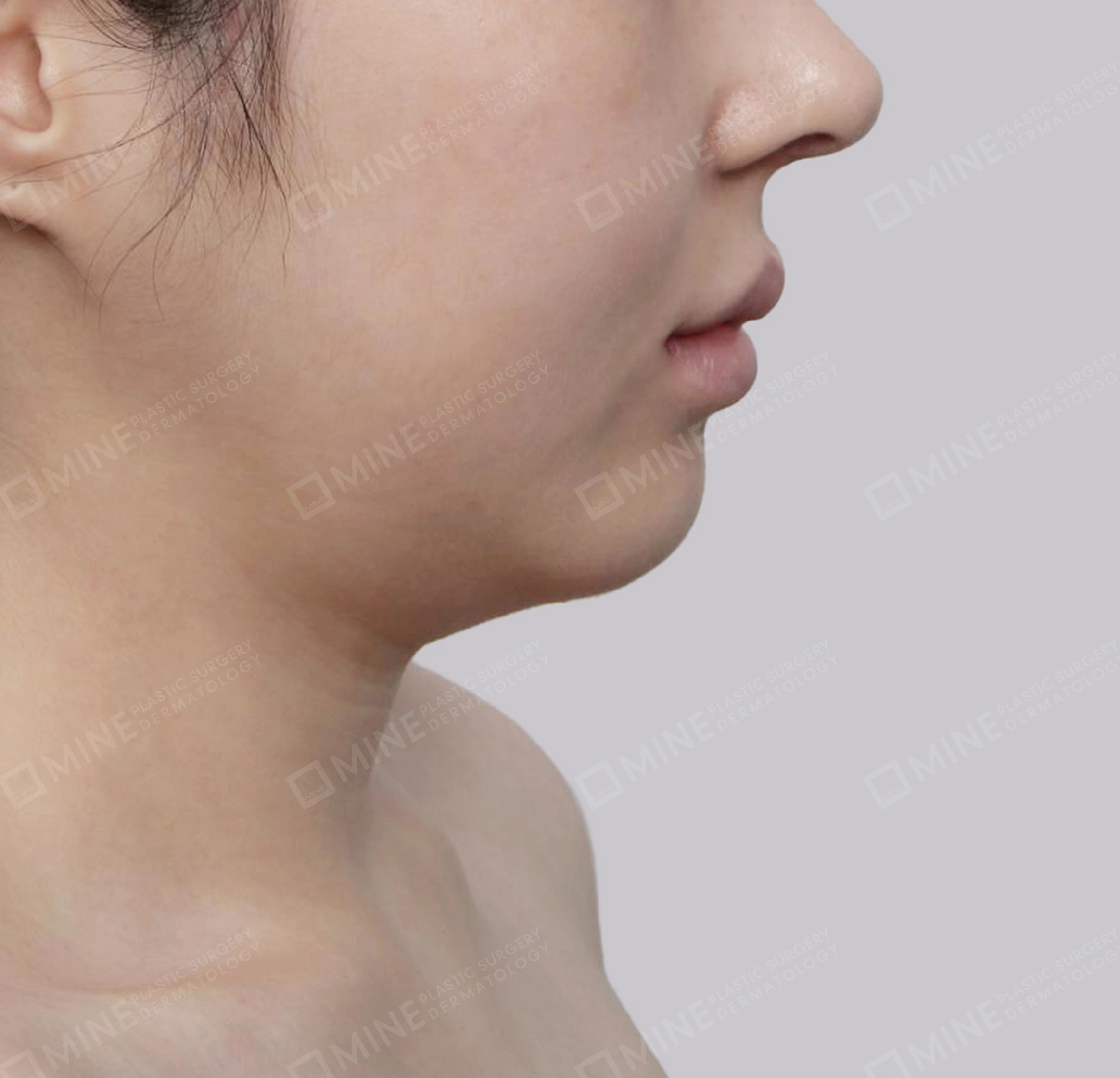 Mini Neck Lift-측면-전