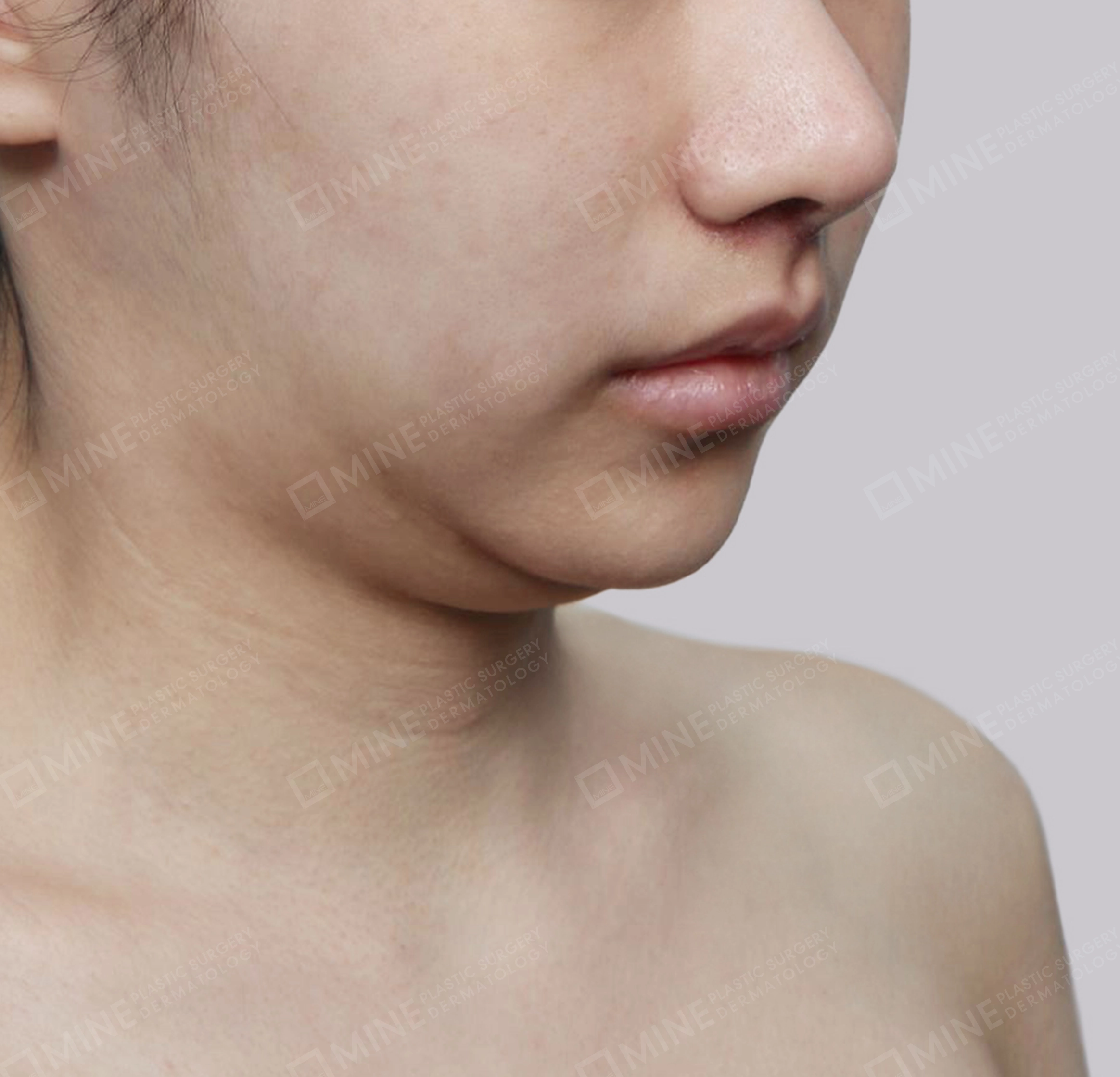 Mini Neck Lift-정면-전