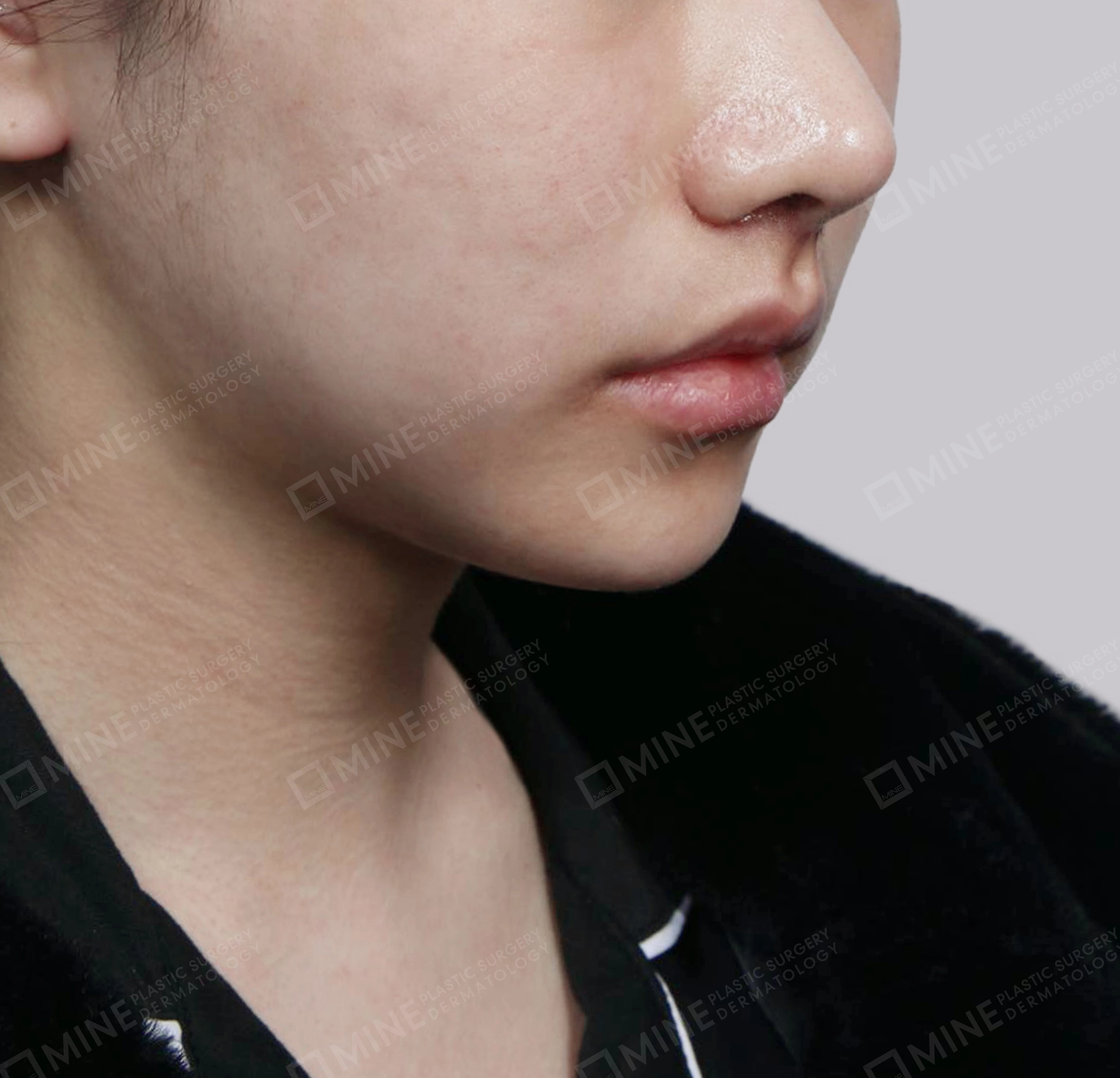 Mini Neck Lift-정면-후