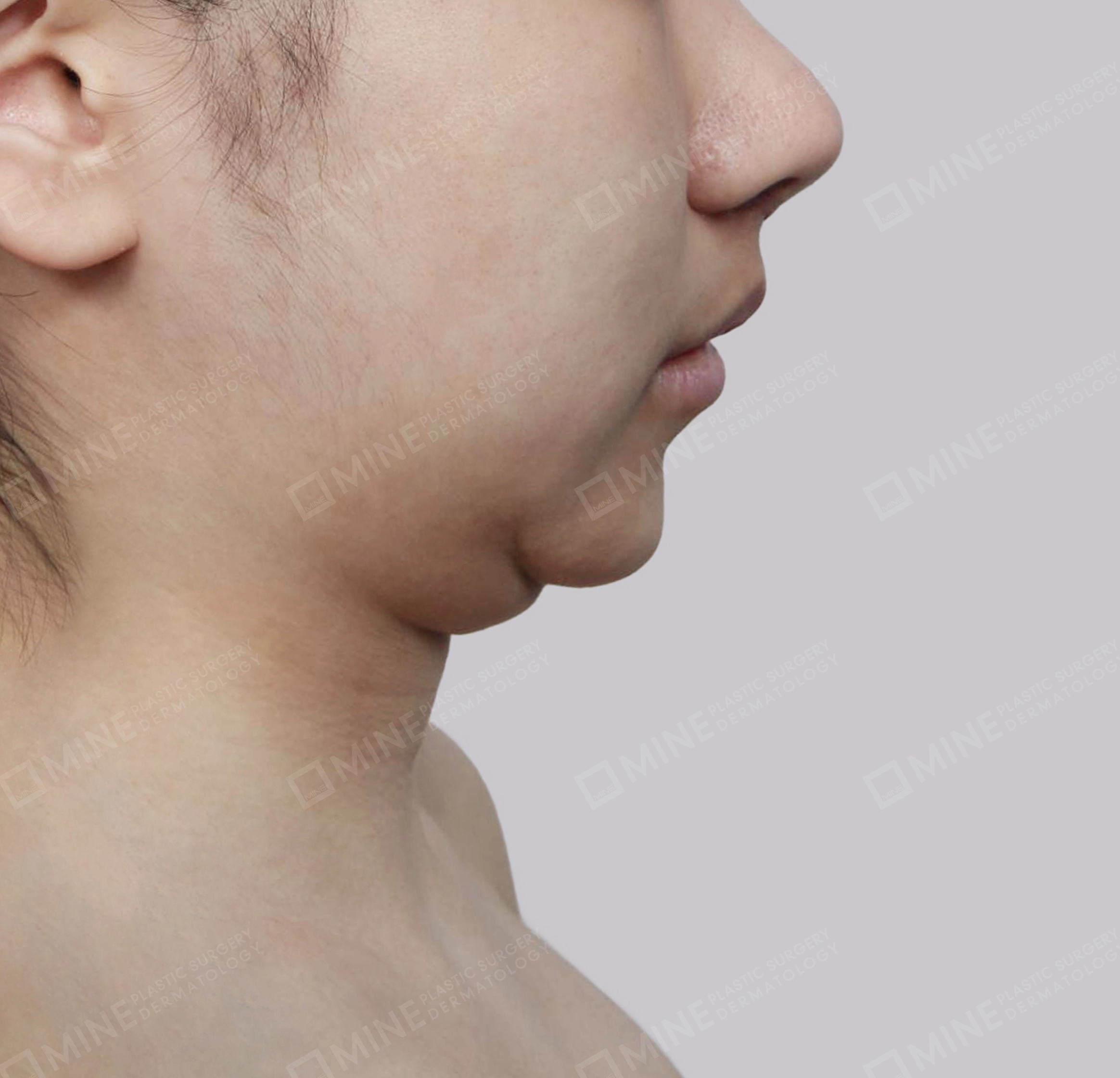 Mini Neck Lift-측면-전