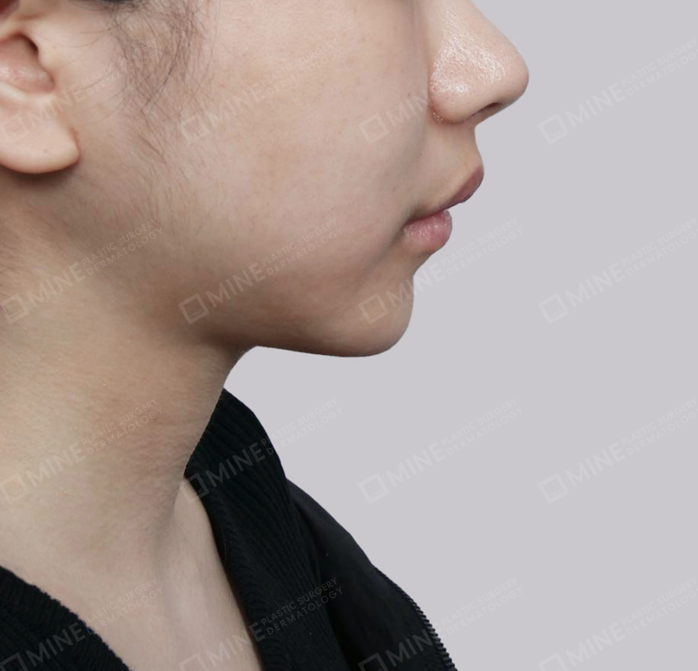 Mini Neck Lift-측면-후