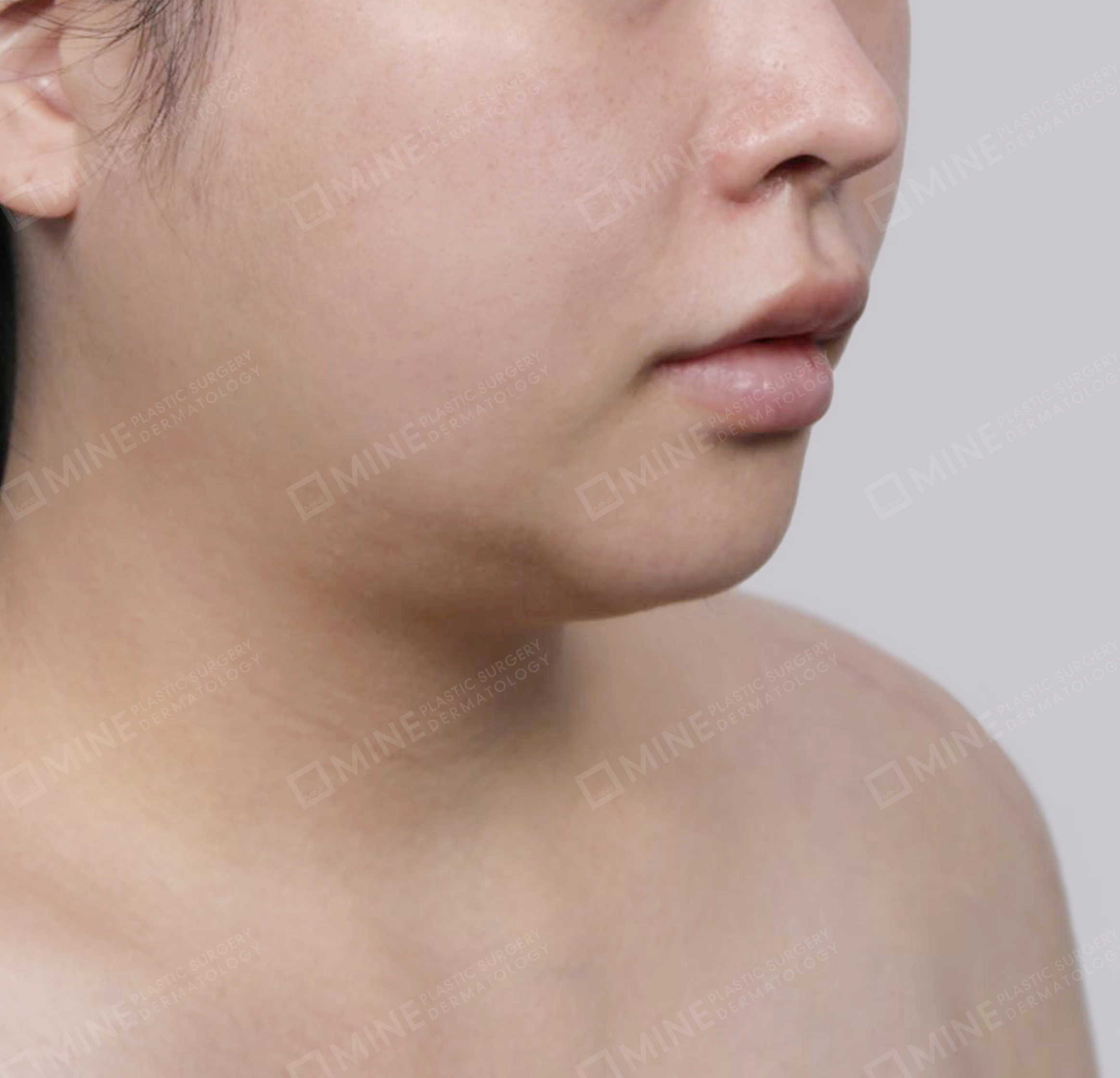 Mini Neck Lift-정면-전