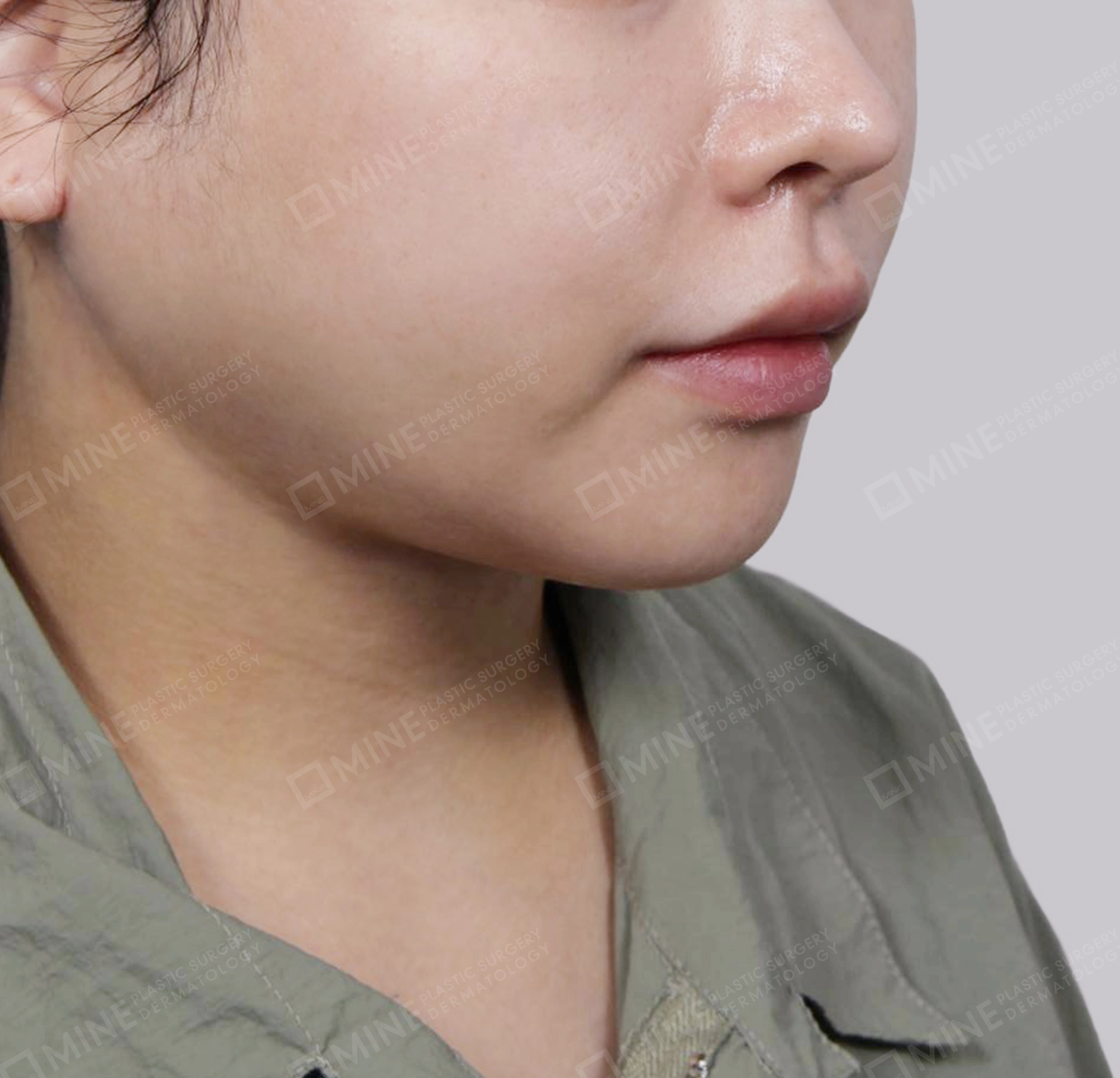 Mini Neck Lift-정면-후