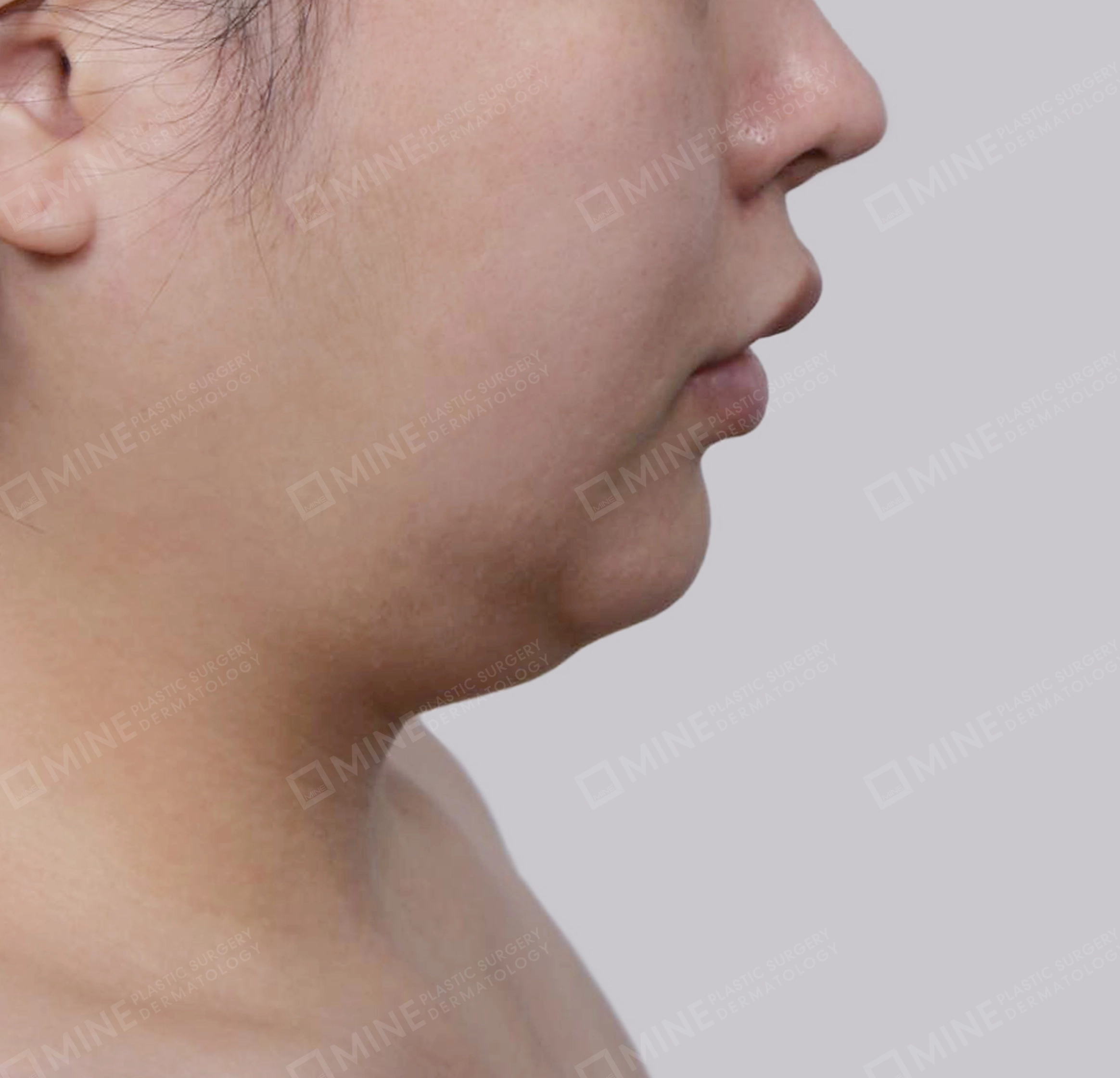Mini Neck Lift-측면-전