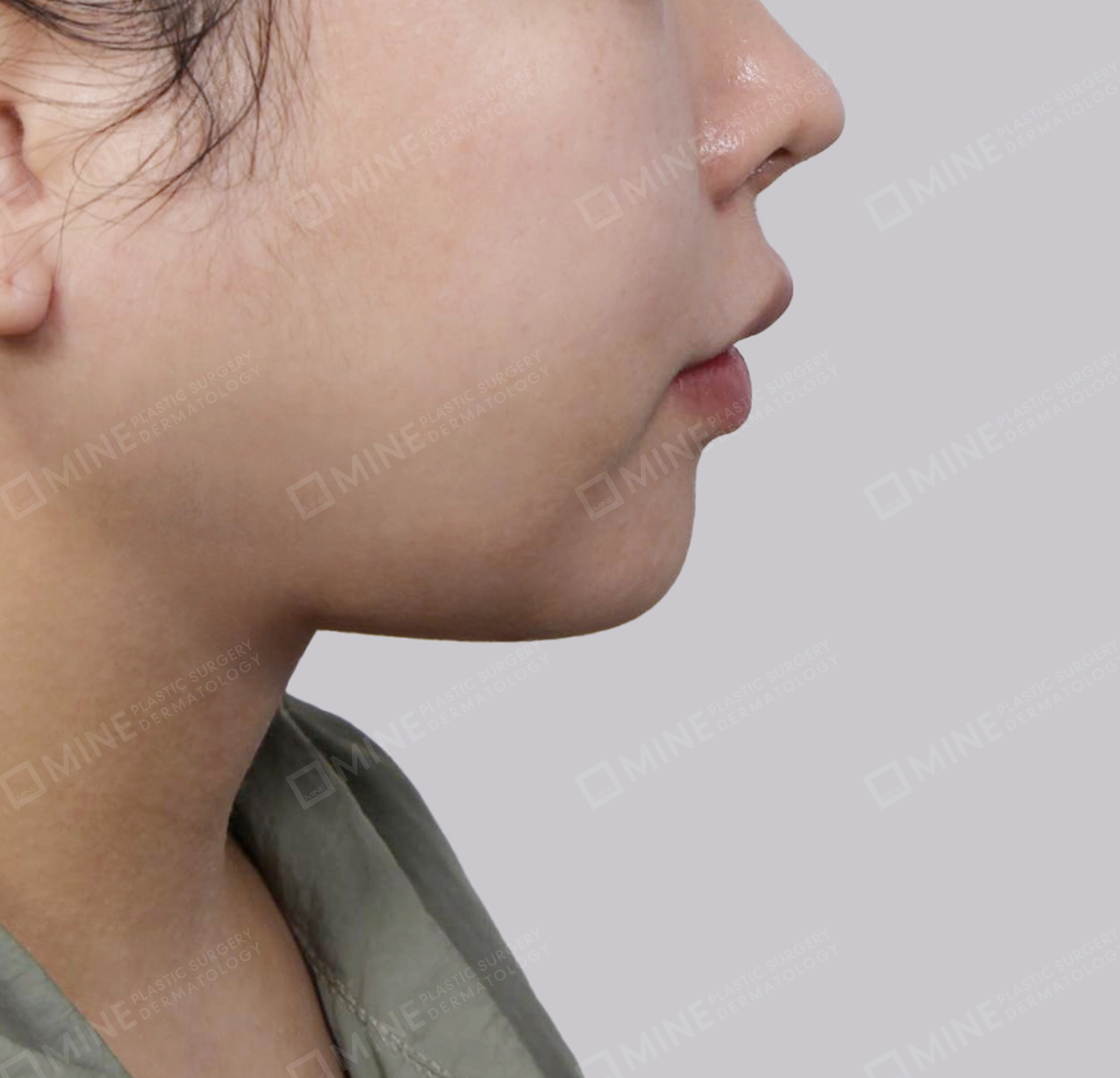 Mini Neck Lift-측면-후