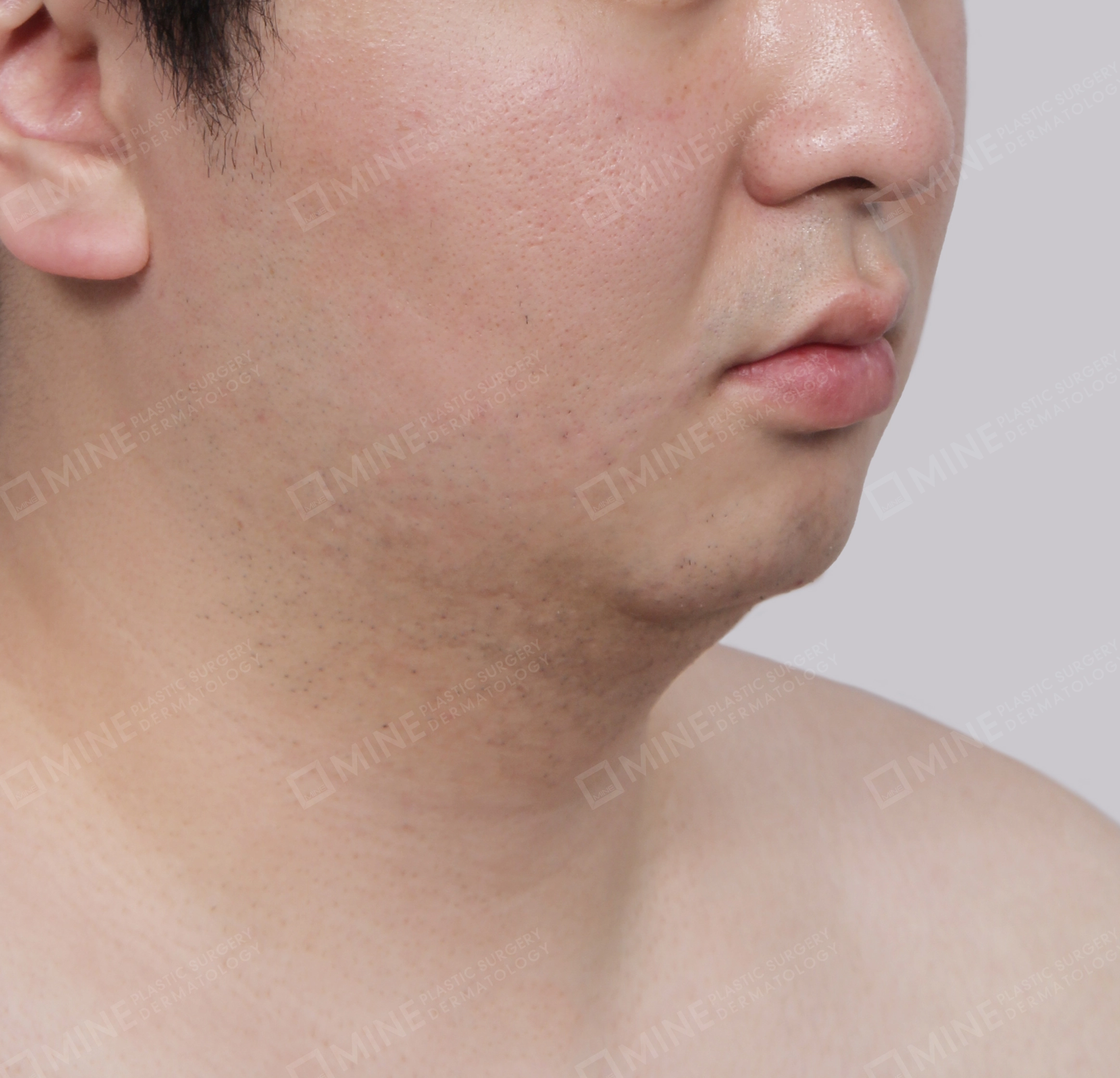 Mini Neck Lift-정면-전