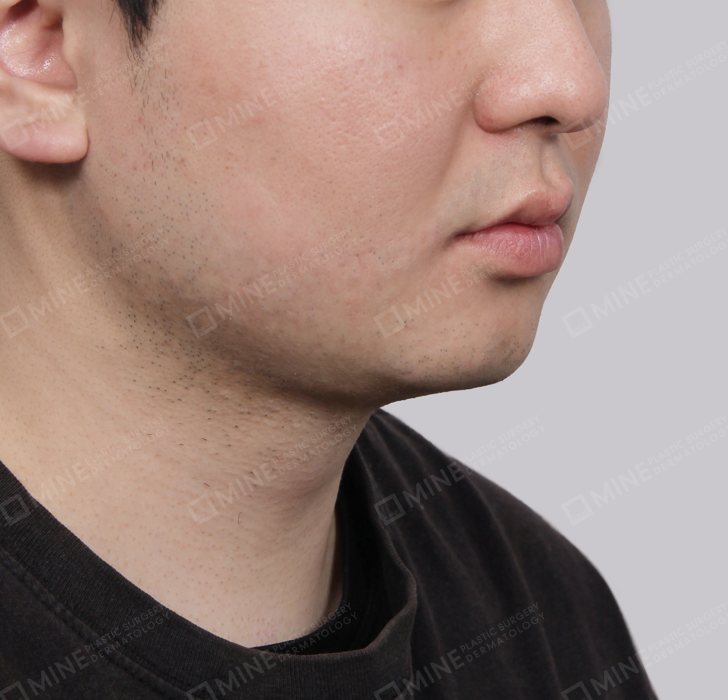 Mini Neck Lift-정면-후