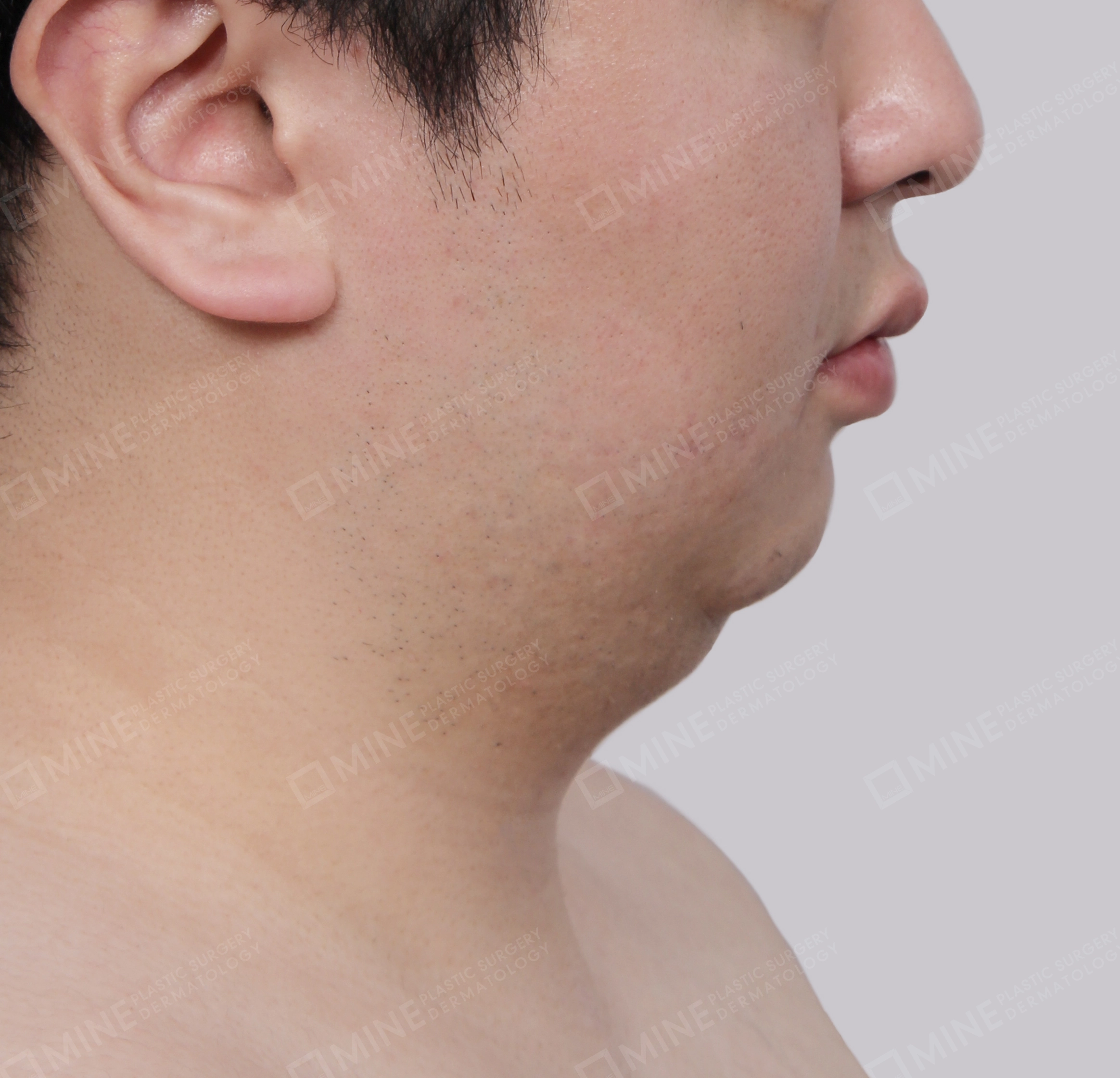 Mini Neck Lift-측면-전