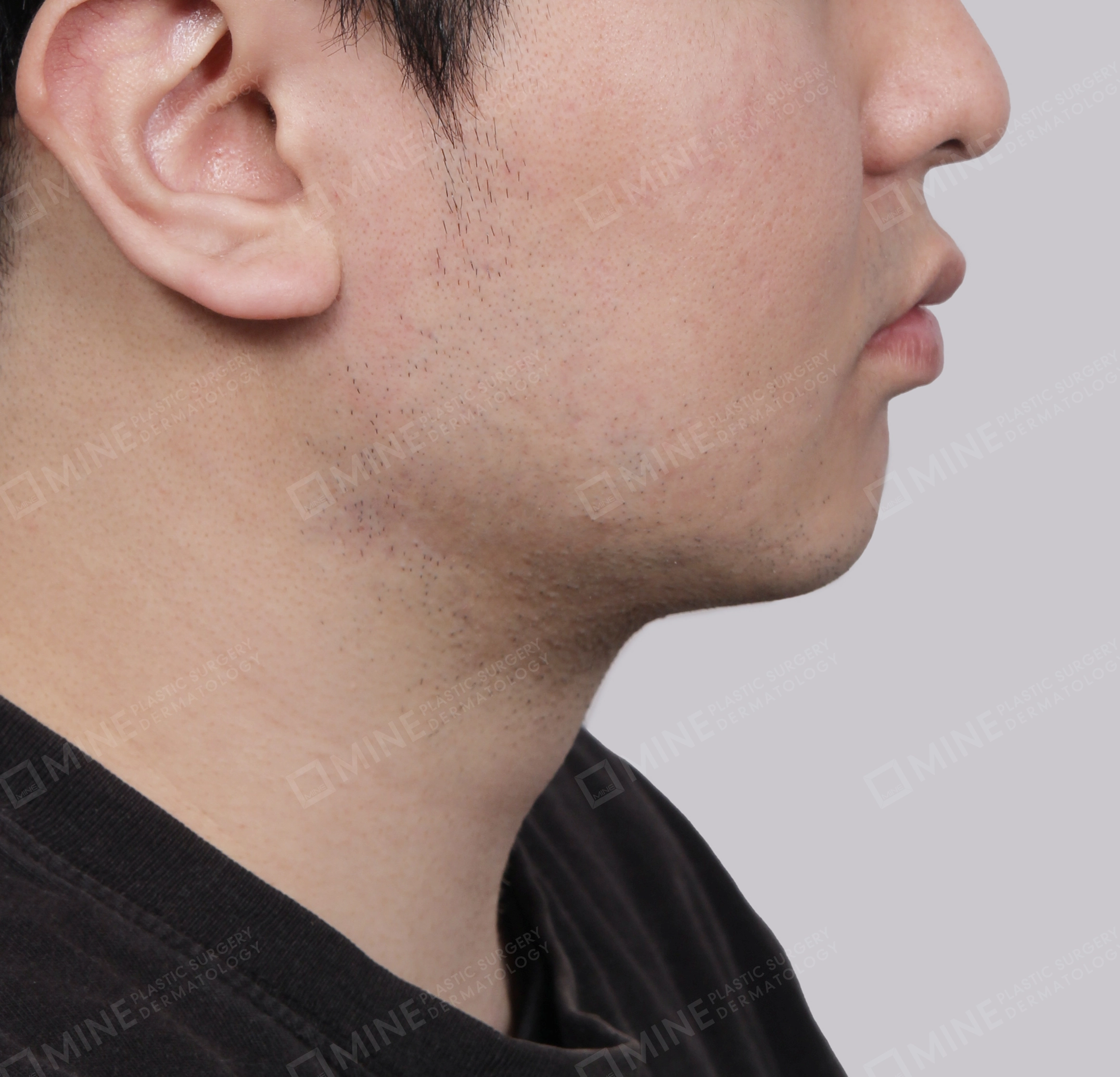 Mini Neck Lift-측면-후