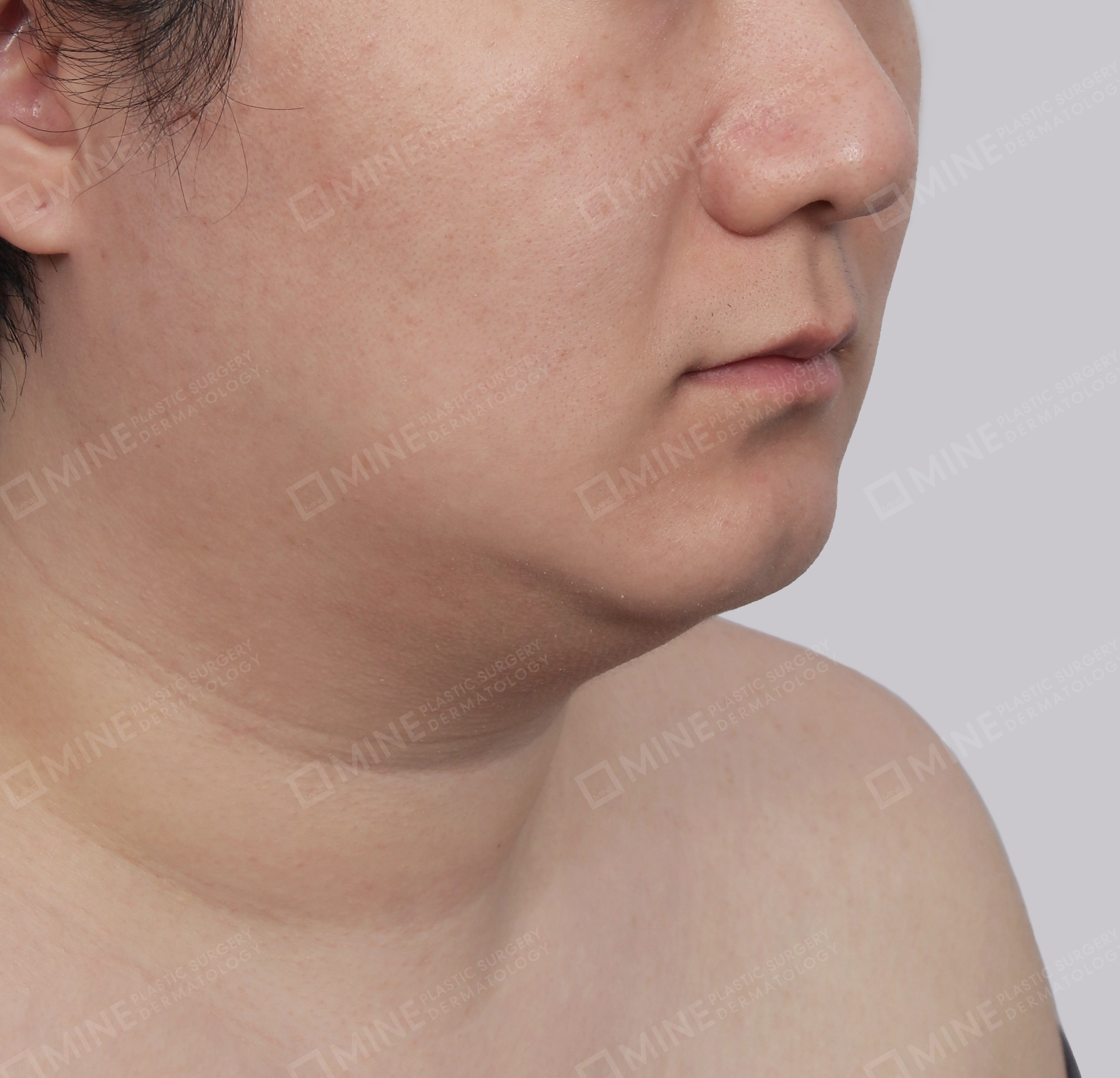 Mini Neck Lift-정면-전
