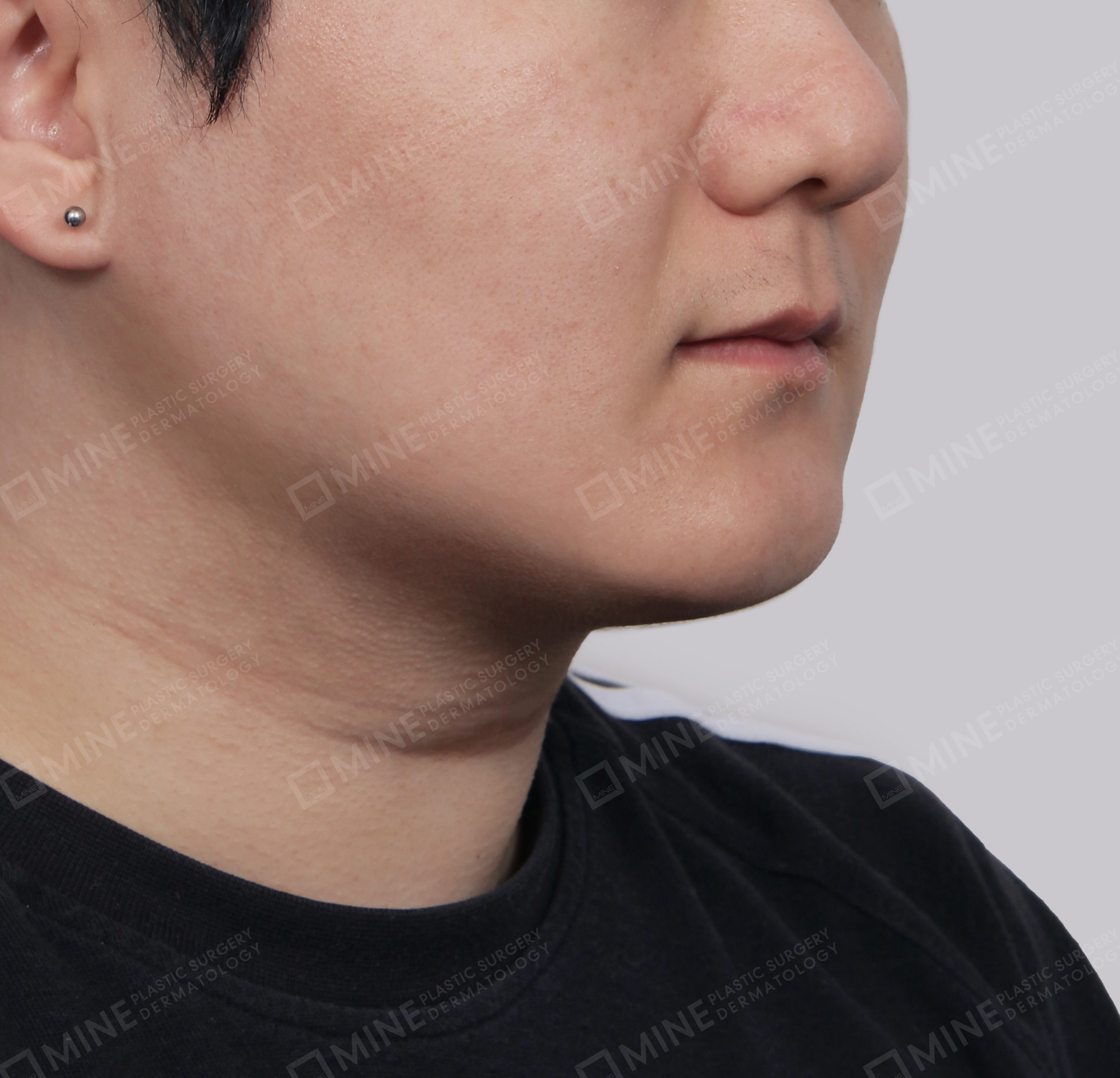 Mini Neck Lift-정면-후